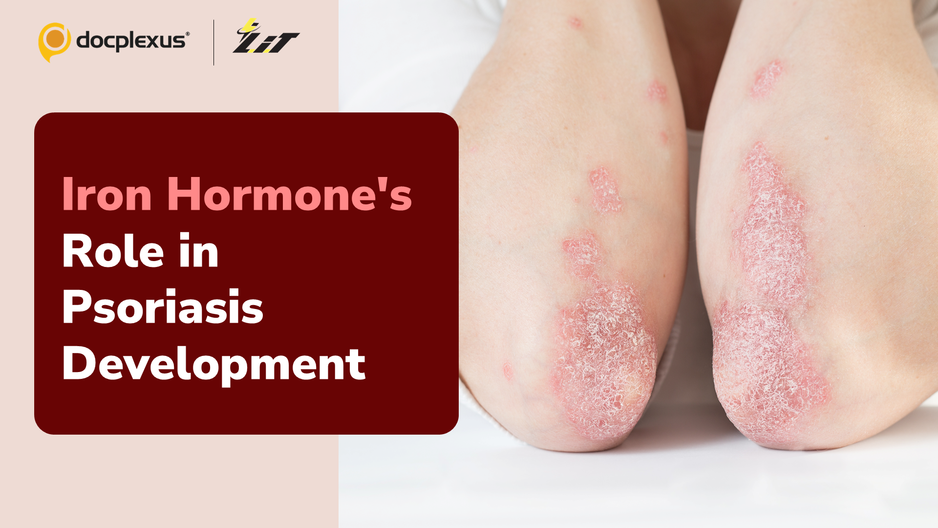 Psoriasis Breakthrough: Could Iron Regulation Hold the Key?