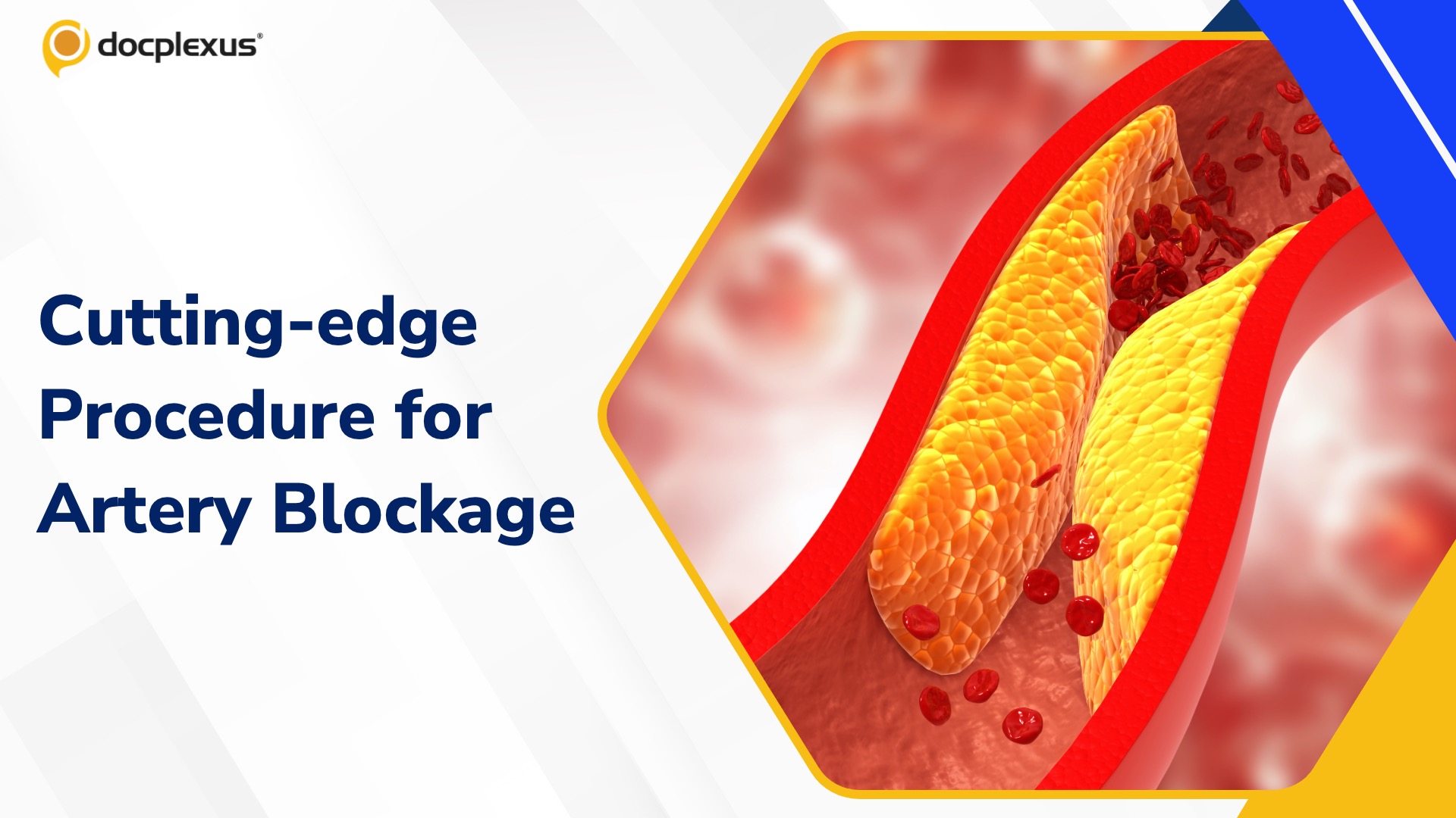 Doctors Use a Cutting-edge Procedure to Treat Artery Blockage
