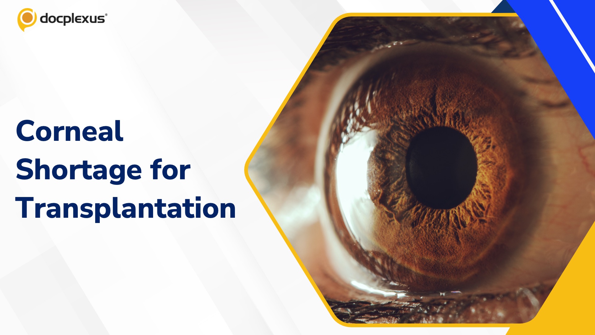 India Faces Severe Shortage of Corneas for Transplantation