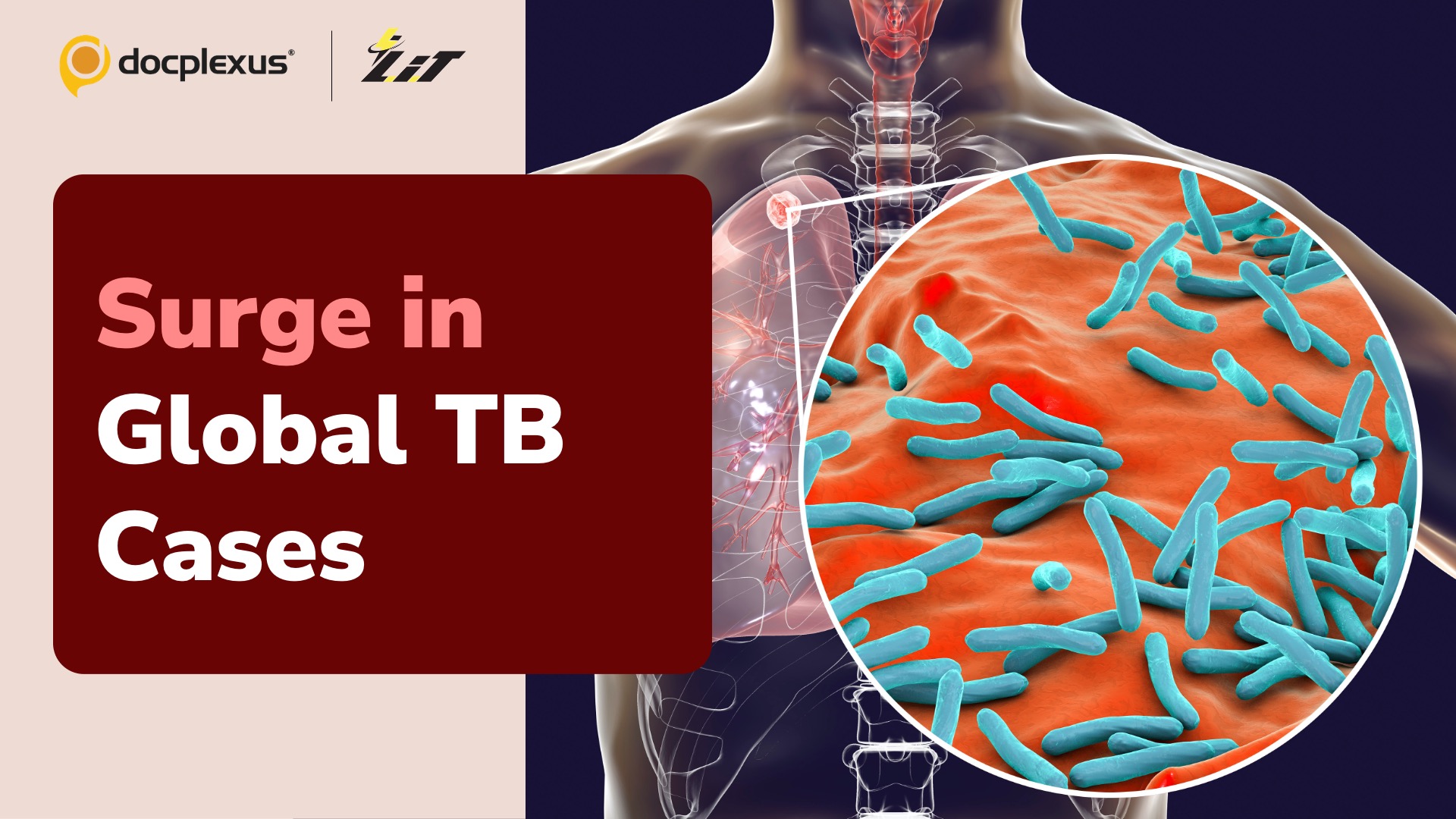 TB Surpasses COVID-19 as Leading Infectious Disease Killer