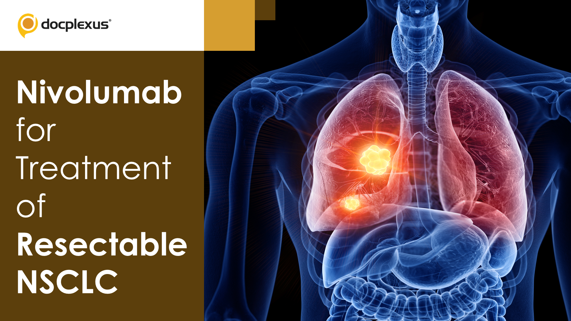 FDA Authorizes Nivolumab for Treatment of Resectable Non-Small Cell Lung Cancer