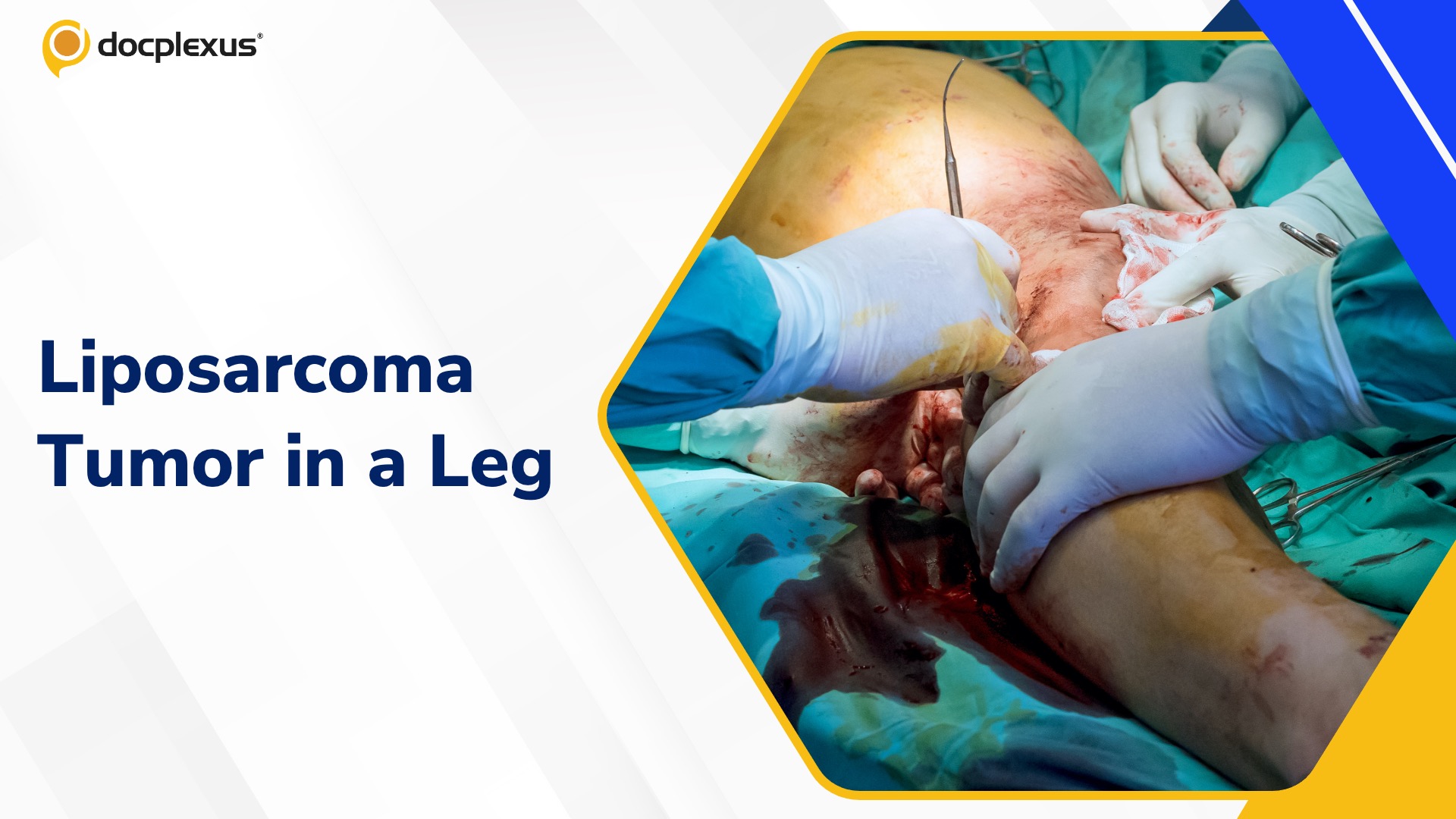 Surgeons Remove Large Liposarcoma Tumor from Patient’s Leg