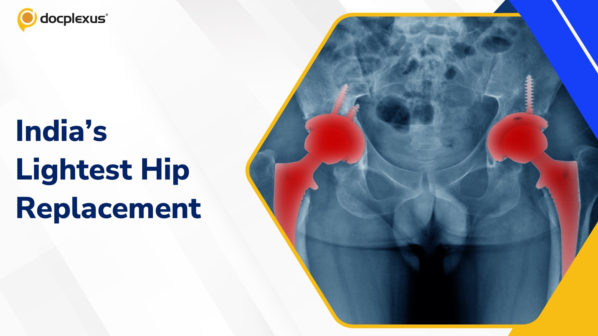 Delhi Surgeon Performs India’s Lightest Bilateral Hip Replacement