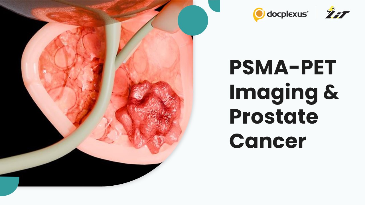 PSMA-PET Imaging Redefines Prostate Cancer Staging