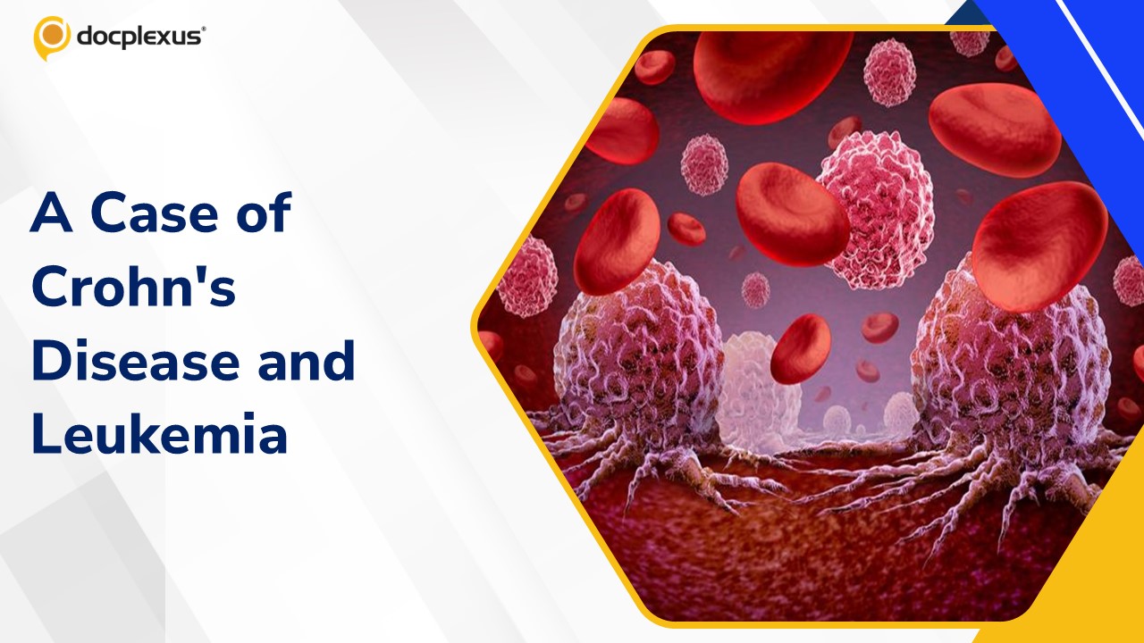 A Unique Case of Therapy-related Leukemia