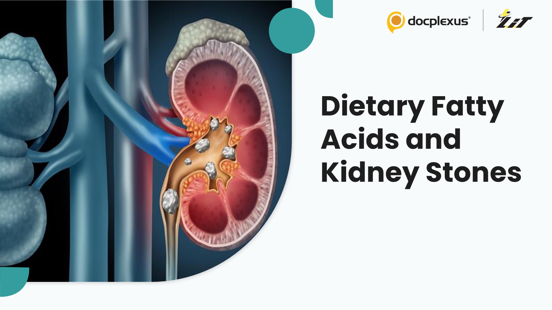 High Dietary Fatty Acid Intake Linked to Increased Kidney Stone Risk