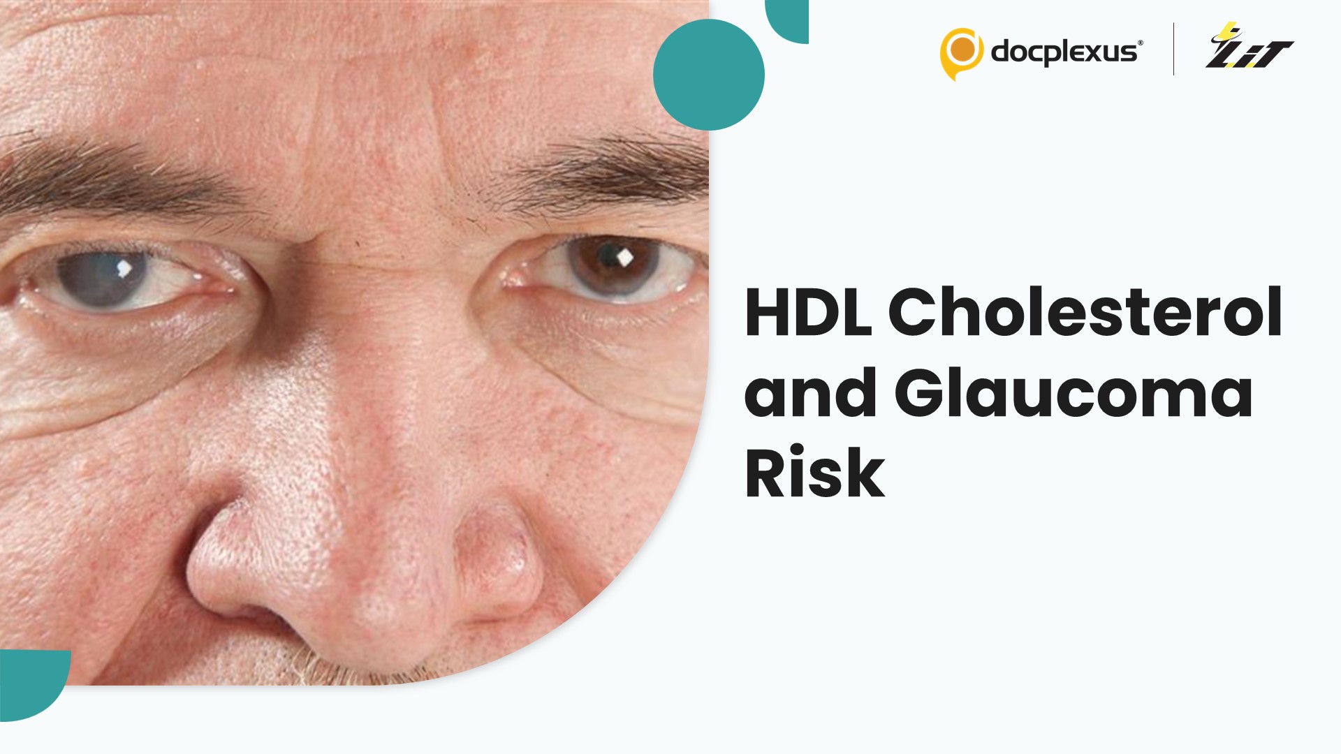 High HDL Cholesterol May Increase Glaucoma Risk