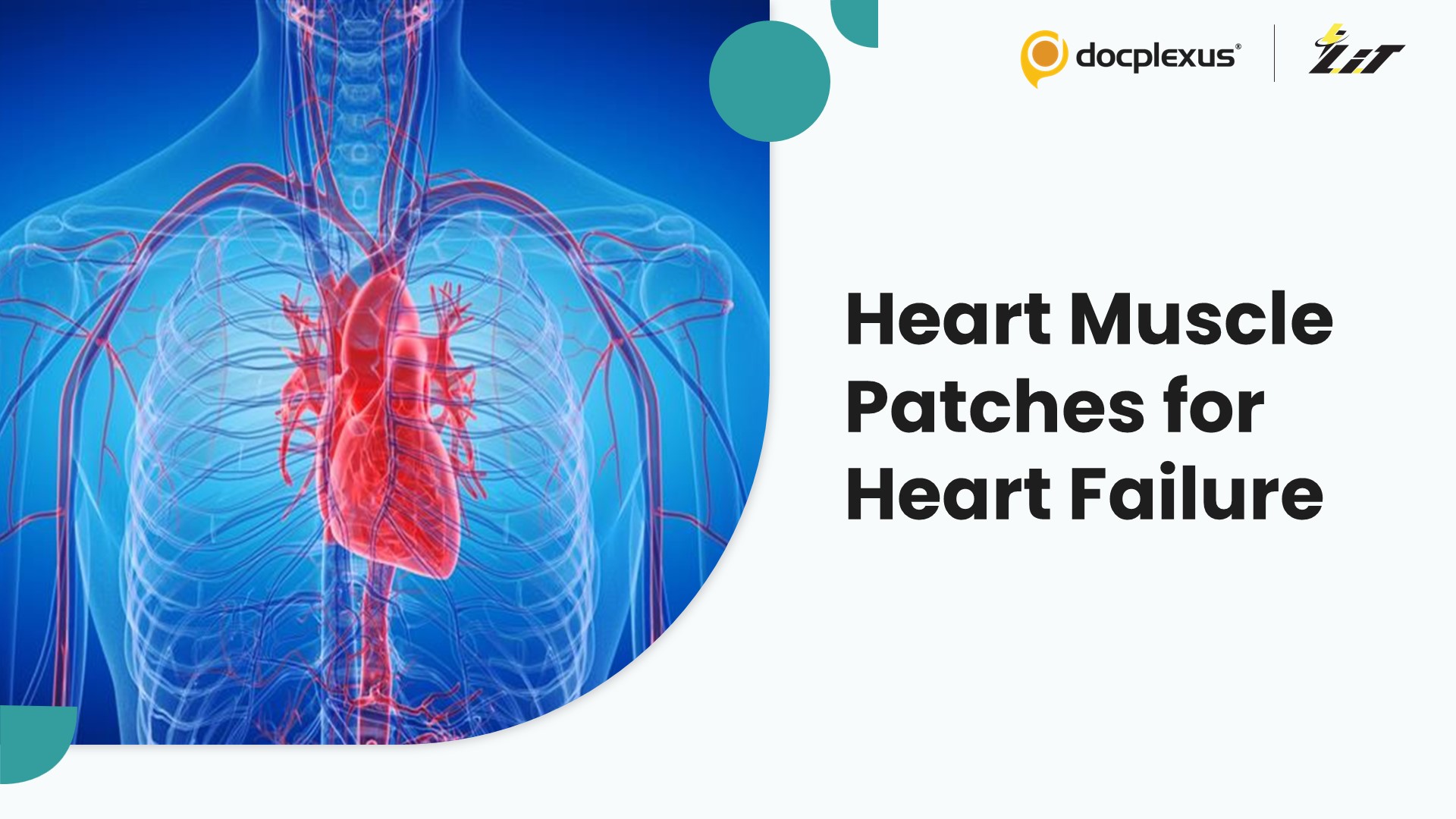 Engineered Heart Muscle Allografts Show Promise in Treating Heart Failure