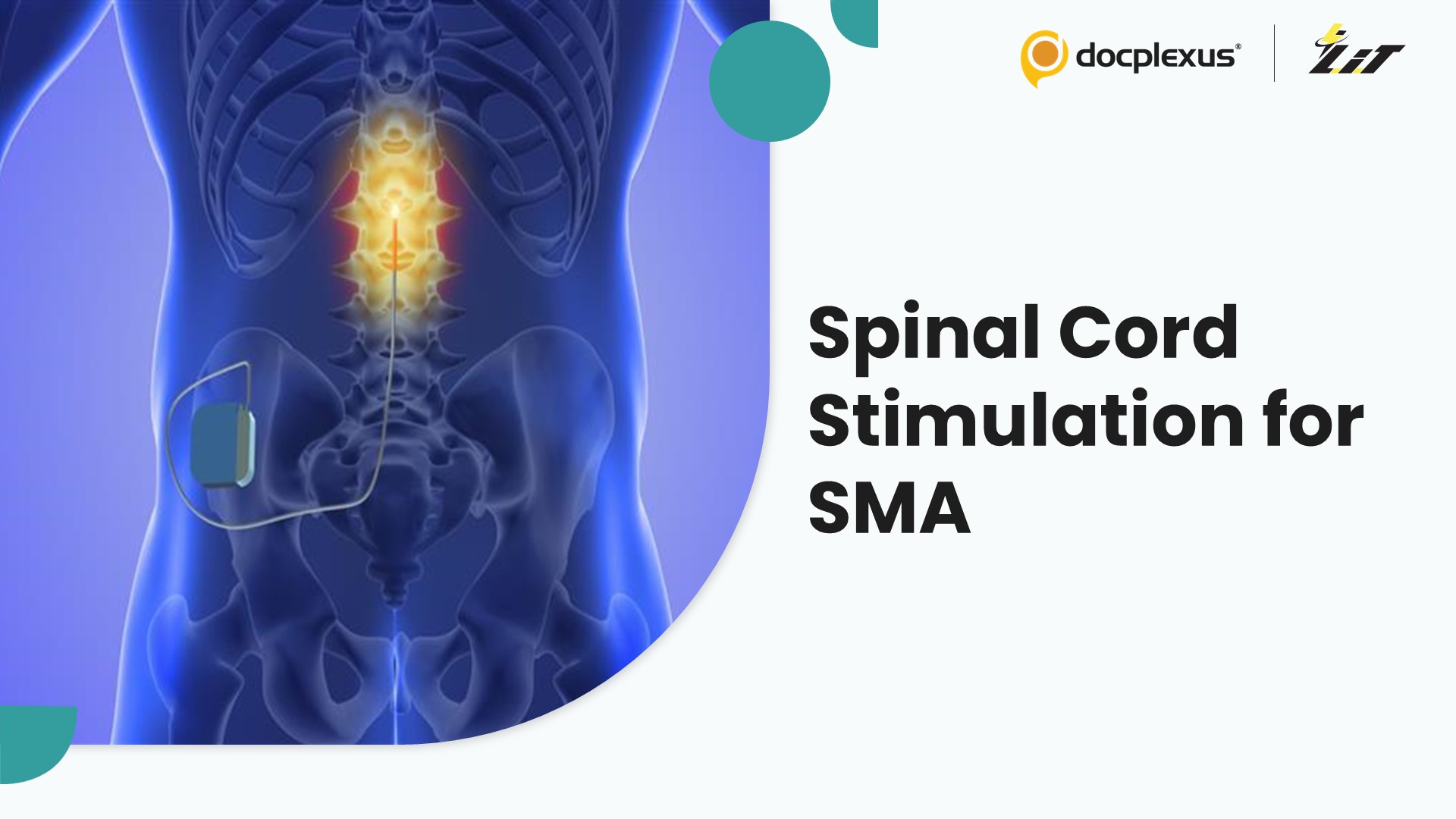 Epidural Spinal Cord Stimulation Enhances Function in Spinal Muscular Atrophy