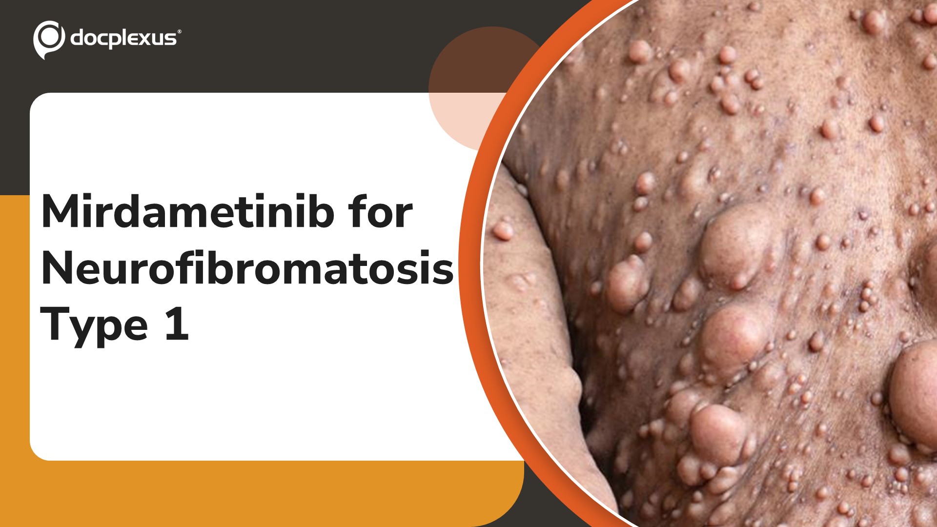 USFDA Approves Mirdametinib for Neurofibromatosis Type 1