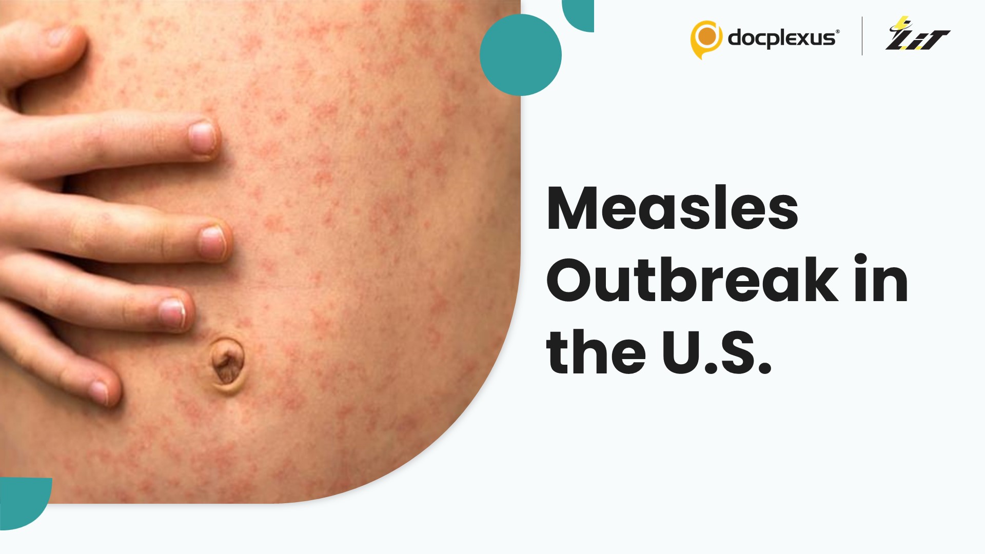 Measles Outbreak Claims Child’s Life in Texas