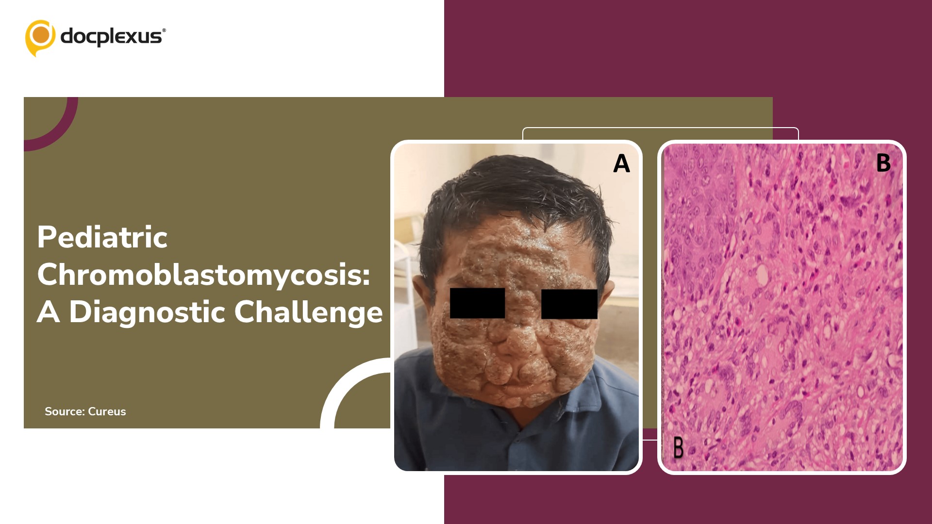 Pediatric Facial Chromoblastomycosis: A Diagnostic Challenge