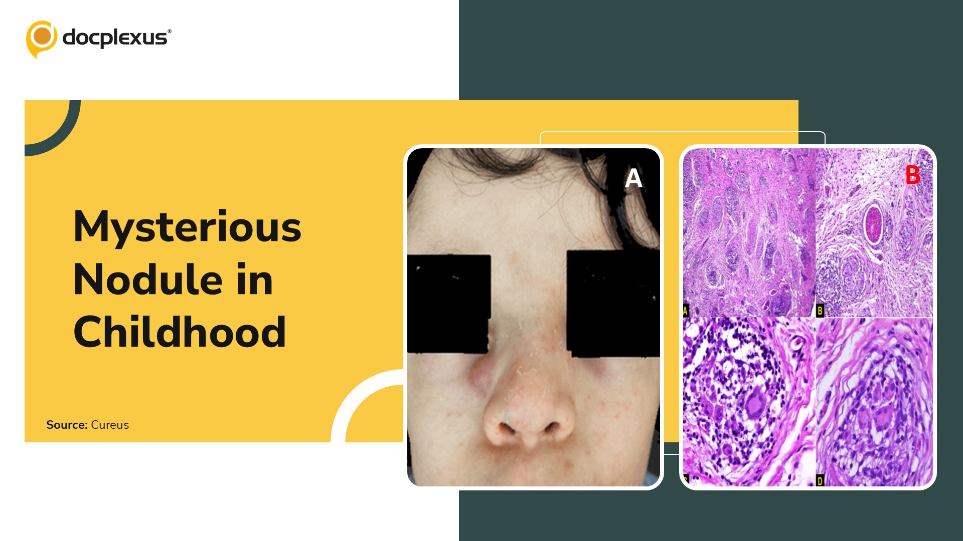 A Rare Facial Lesion in a Young Child