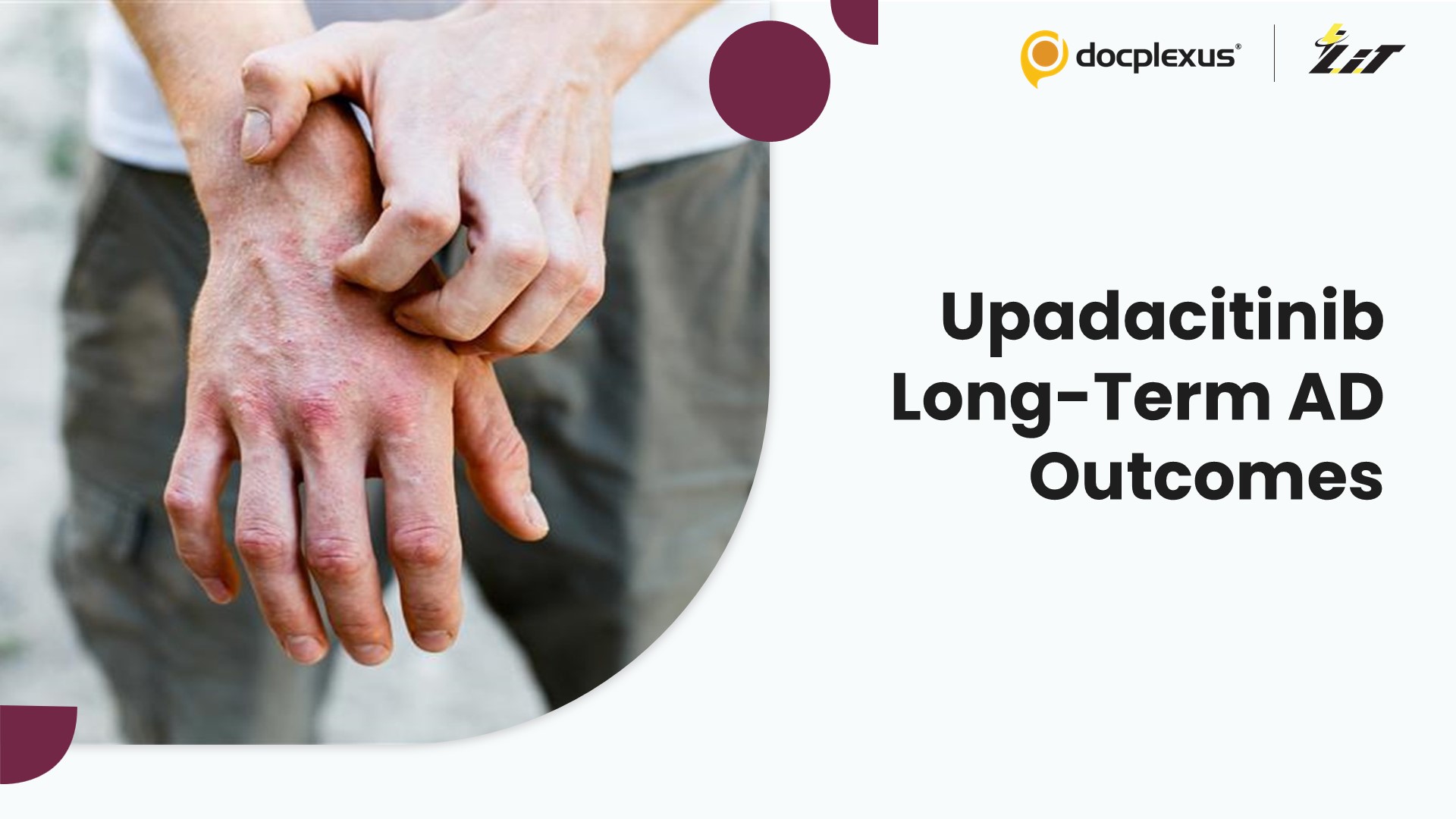 Long-Term Efficacy and Safety of Upadacitinib in Moderate-to-Severe Atopic Dermatitis