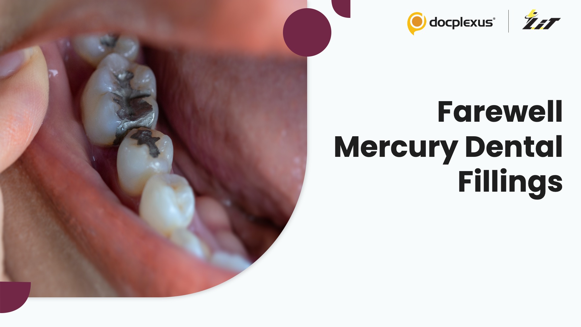 The World is Saying Goodbye to Mercury Dental Fillings by 2034