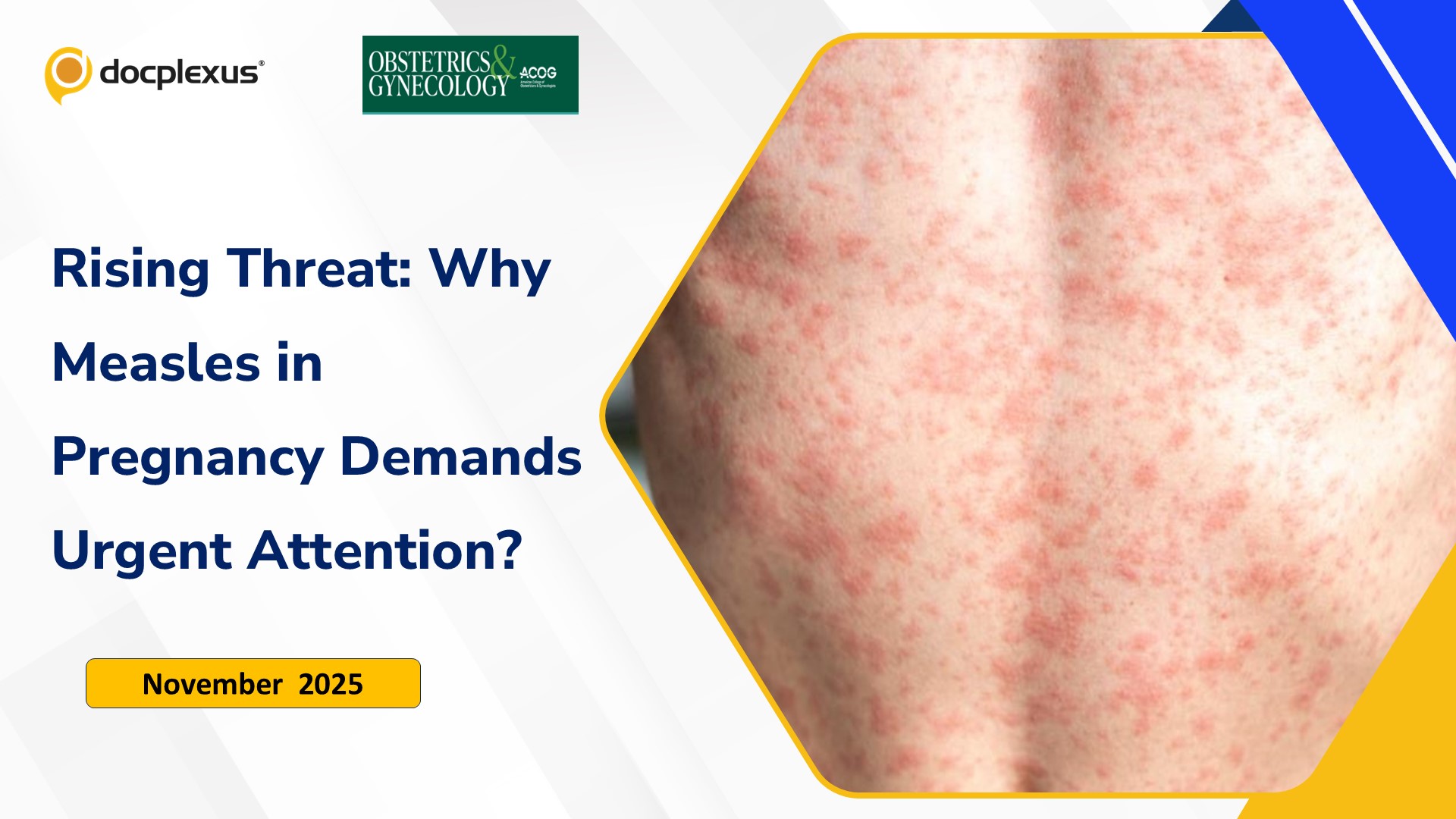 Rising Threat: Why Measles in Pregnancy Demands Urgent Attention?