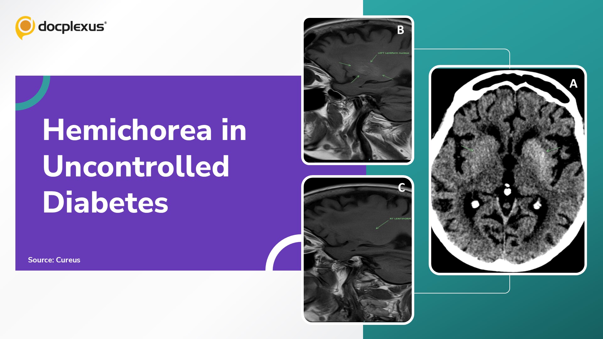 Hemichorea as an Unusual Presentation of Uncontrolled Diabetes Mellitus