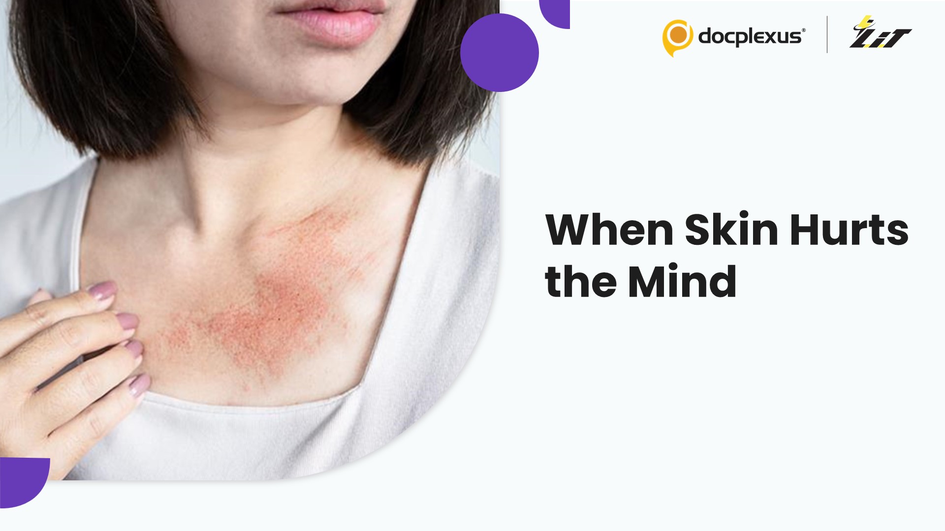 Atopic Eczema’s Hidden Link to Suicidal Thoughts