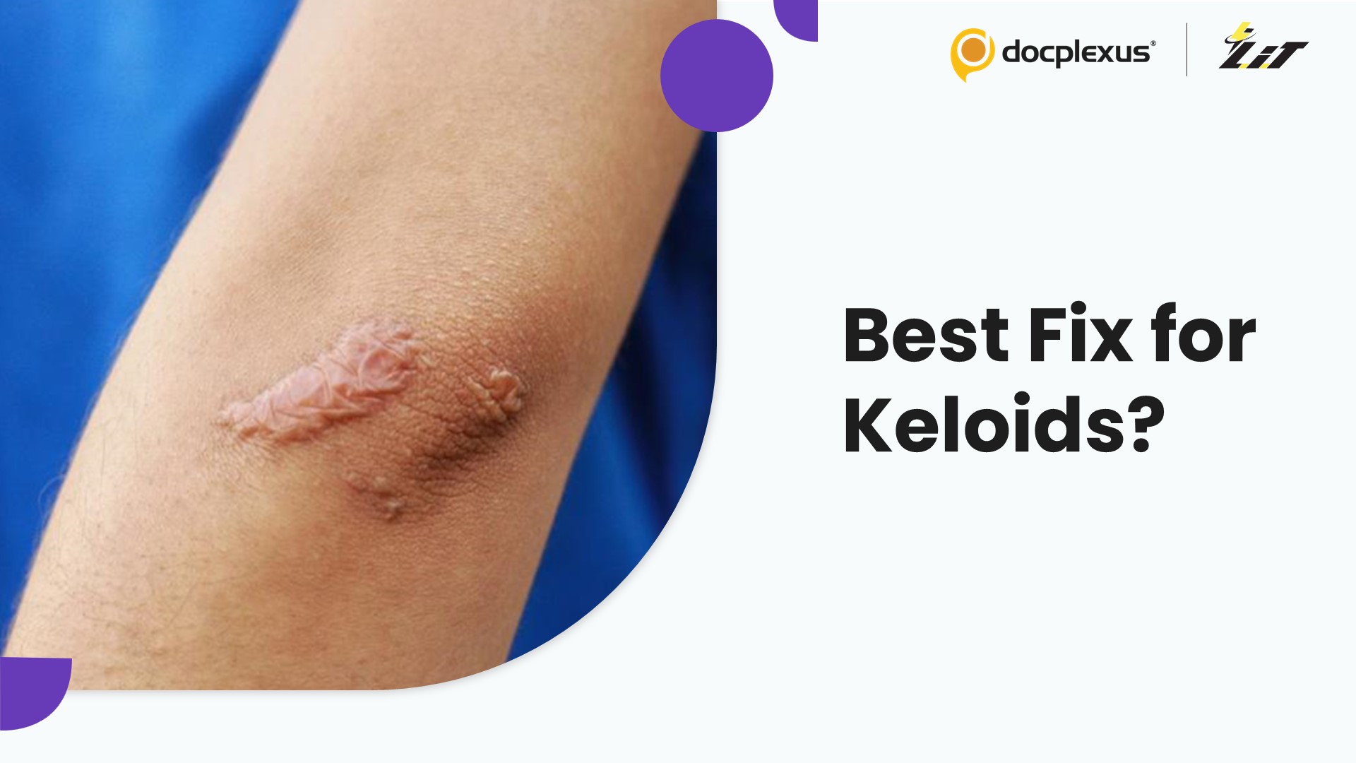 Cracking the Keloid Code: Which Treatment Truly Works Best?