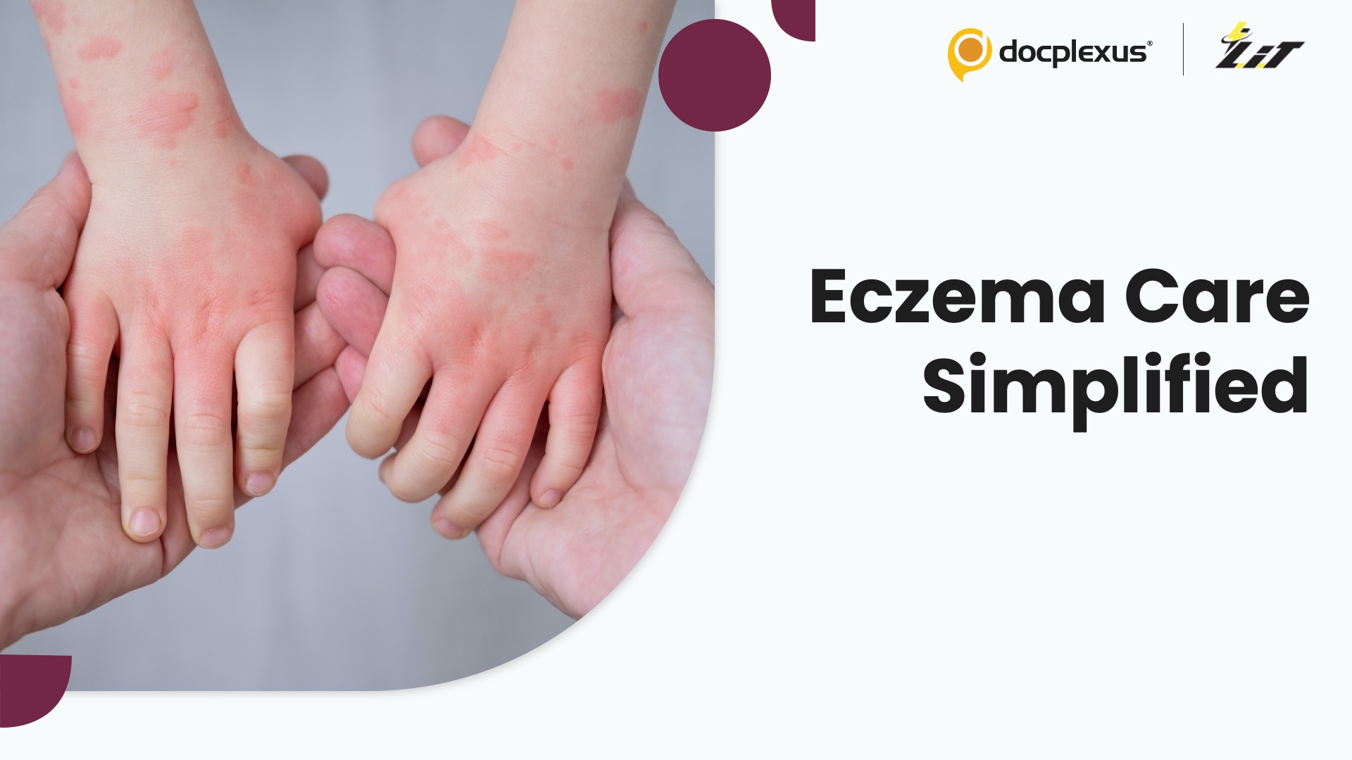 Bathing Frequency Doesn’t Affect Eczema