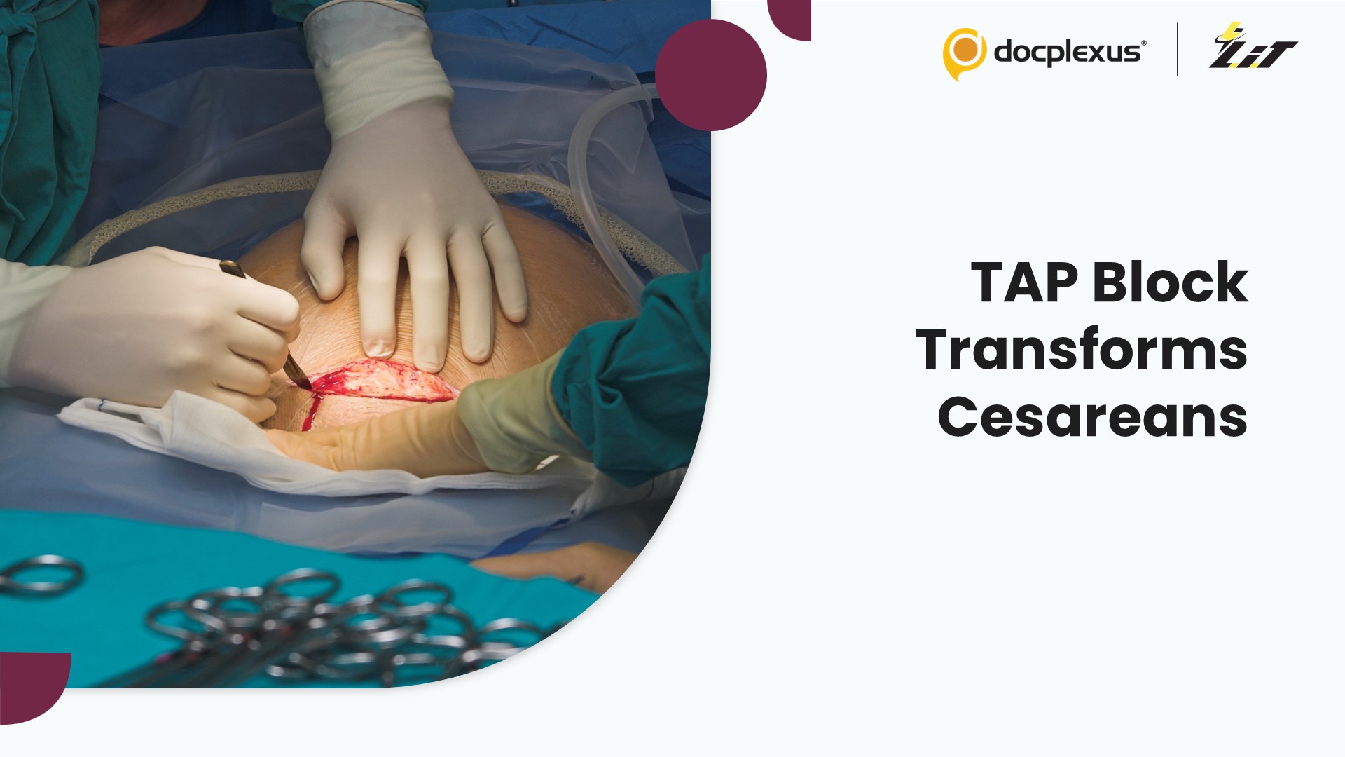 Easing the Pain: How TAP Blocks Transform Cesarean Recovery