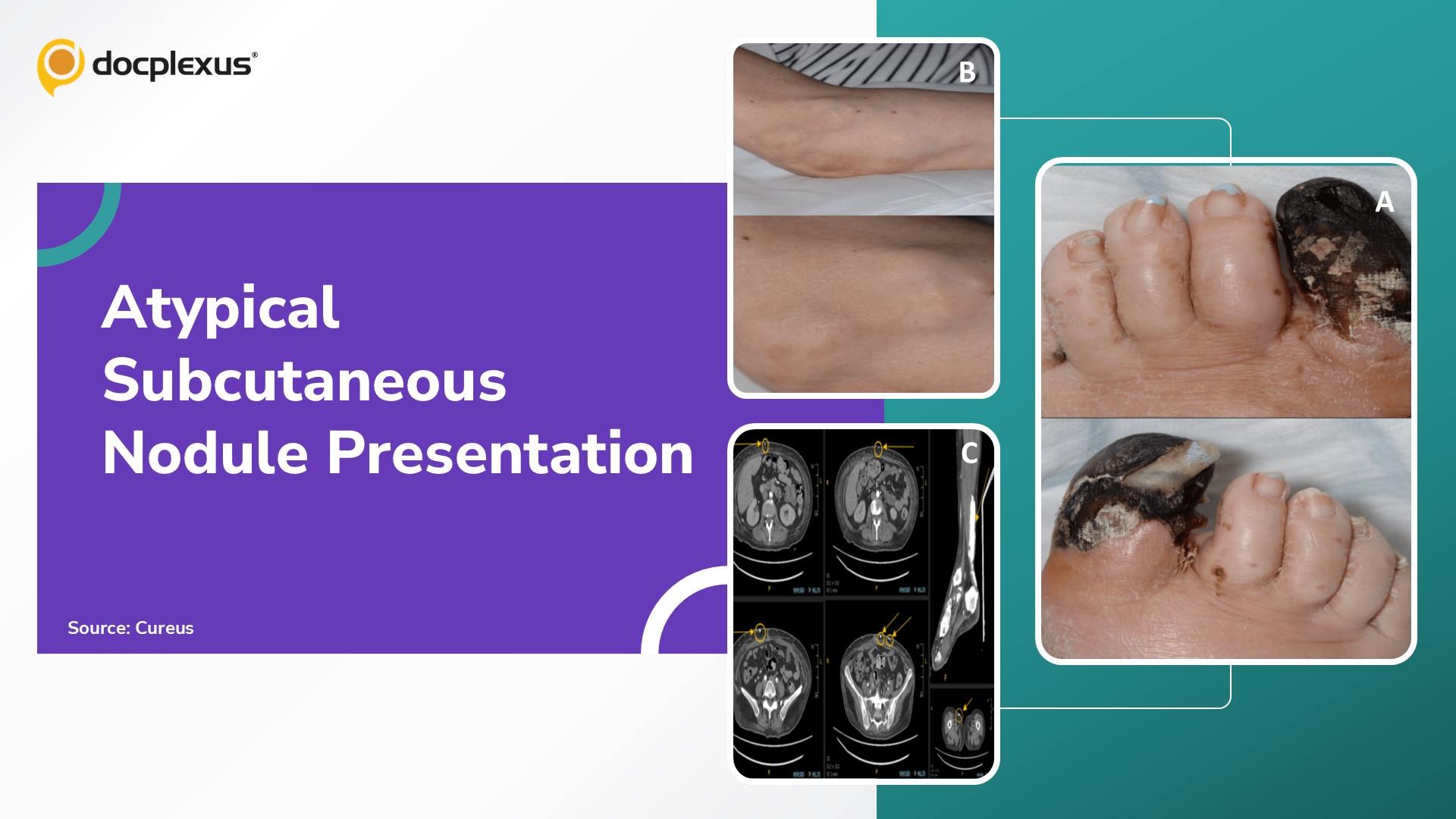 Subcutaneous Nodules: A Rare and Atypical Presentation