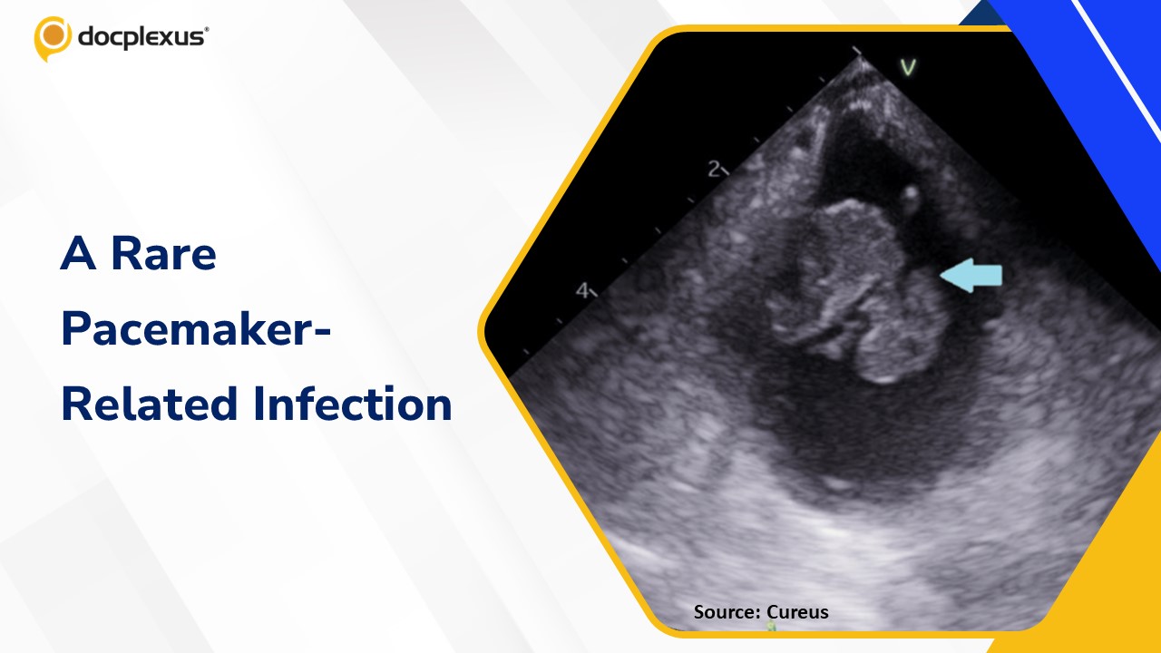A Rare Pacemaker-Associated Cardiac Infection in an Elderly Patient