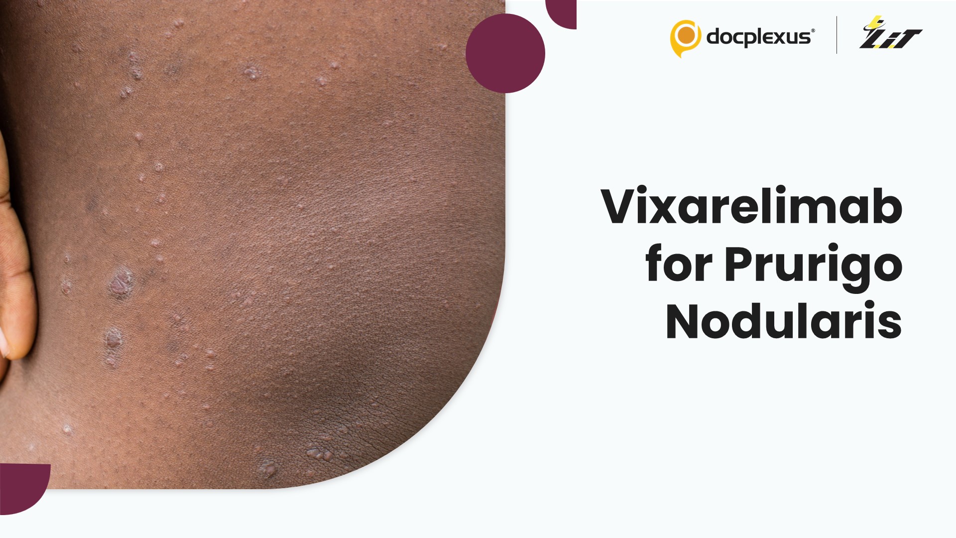 Vixarelimab: An Emerging Therapy for Prurigo Nodularis