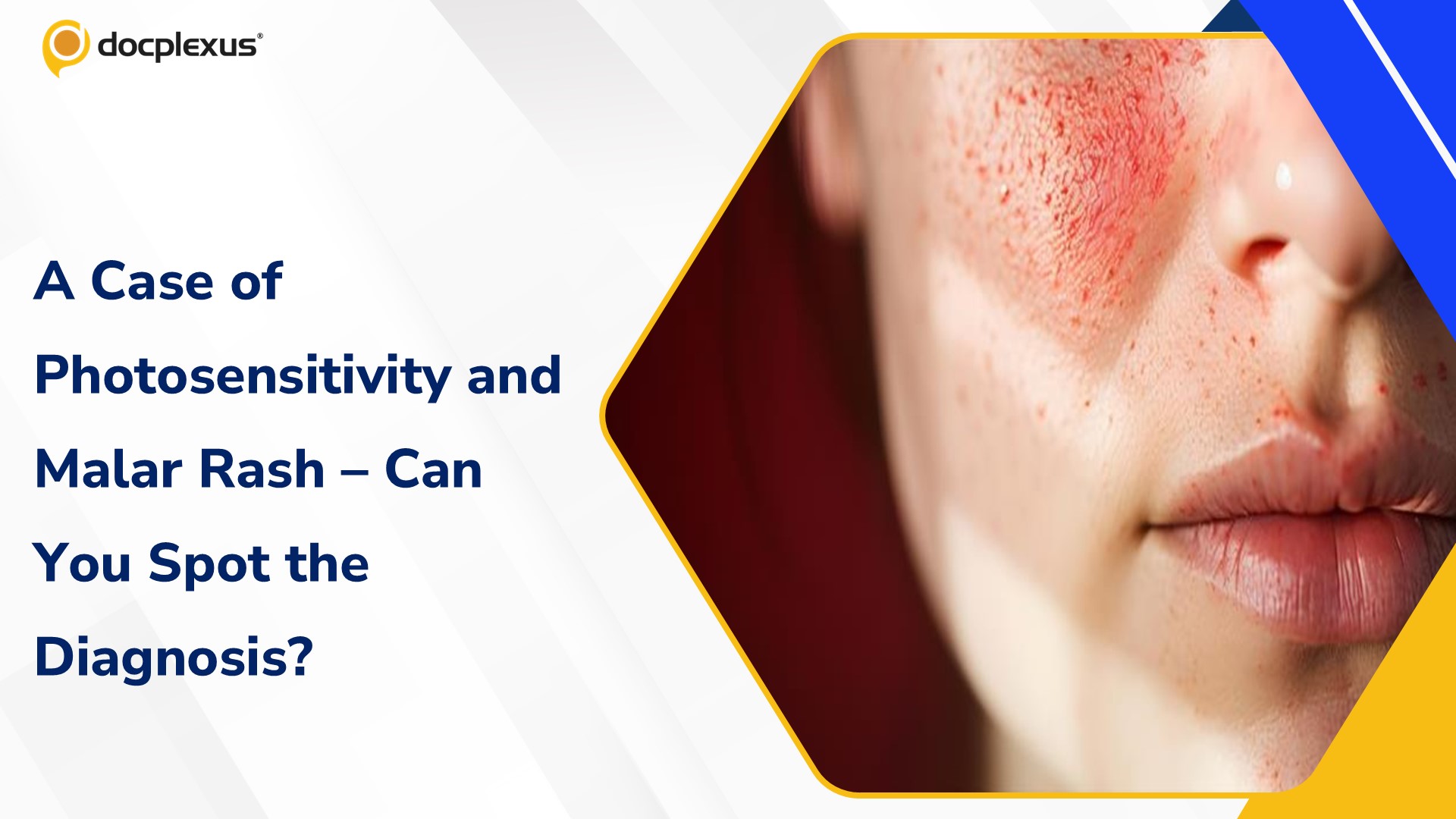 Clinical Challenge: A Young Woman with Photosensitivity and Malar Rash