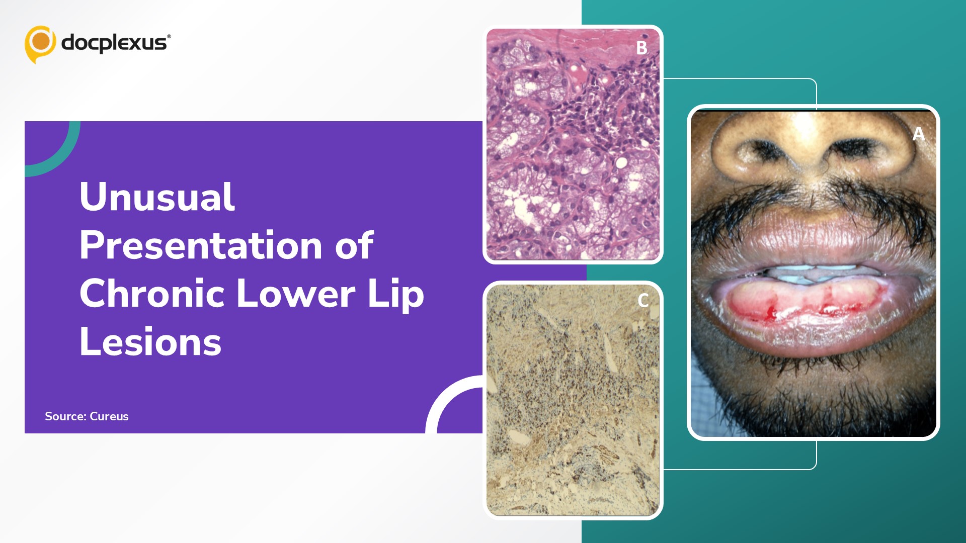 Chronic Lower Lip Ulcerative Lesions: A Diagnostic Challenge