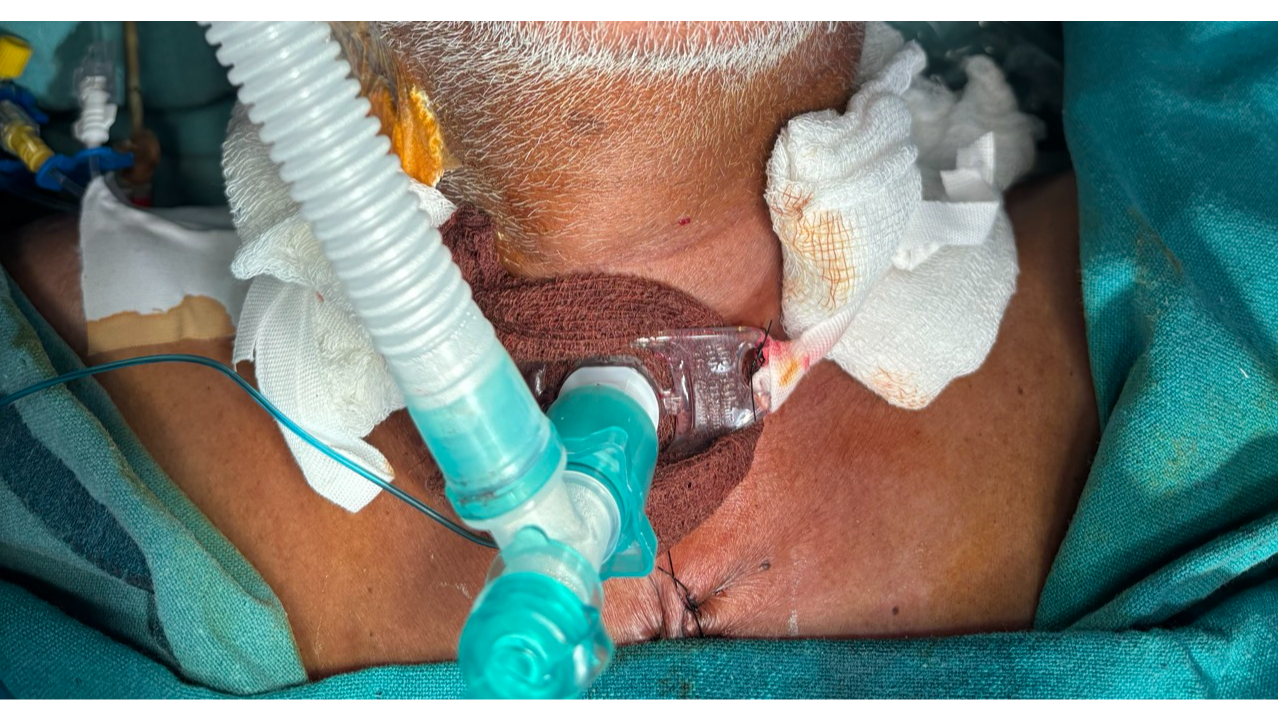 My First Independent Tracheostomy: A CTVS Resident’s Journey from Observation to Execution