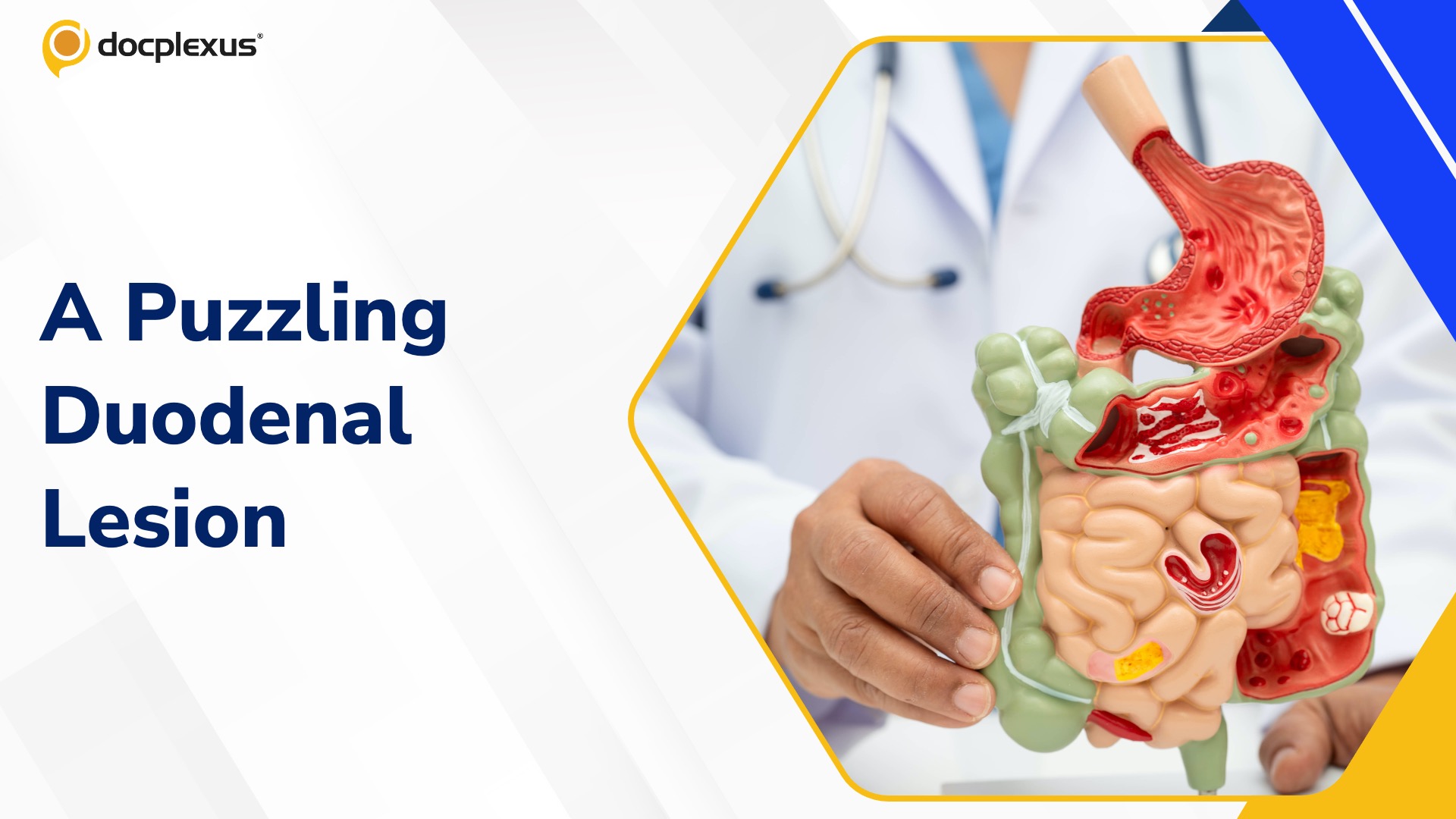 An Unusual Cause of Severe Intestinal Obstruction in a 40-Year-Old Man