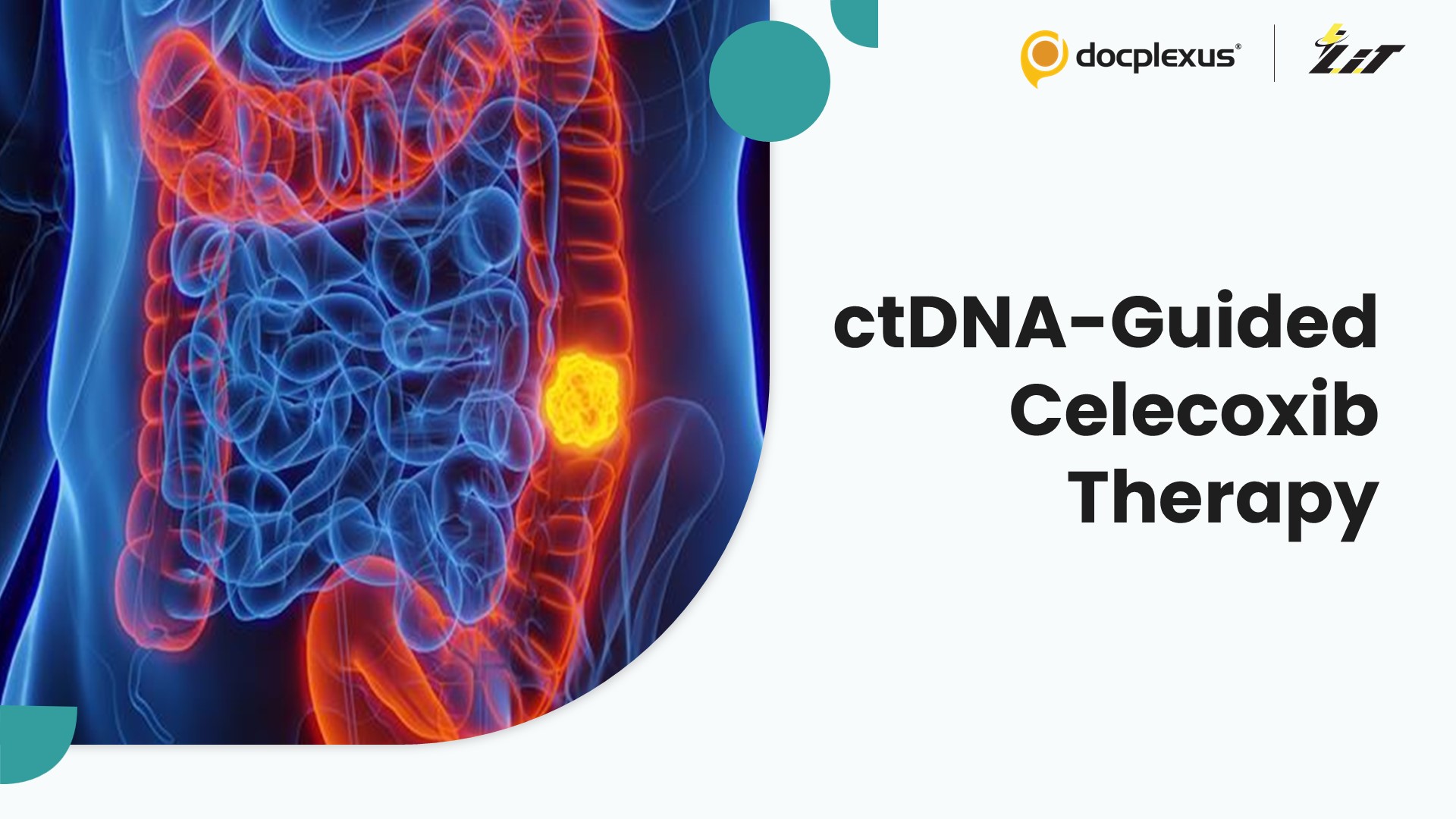 ctDNA-Guided Adjuvant Celecoxib in Stage III Colon Cancer