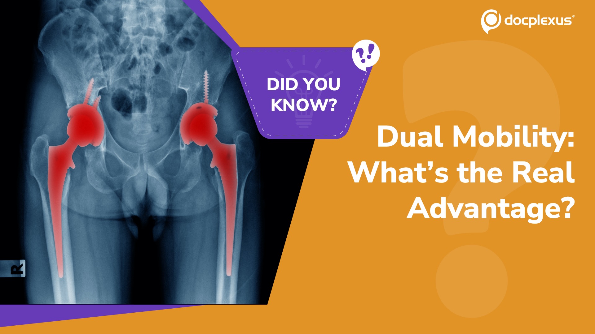 What Truly Makes Dual Mobility Hips More Stable?