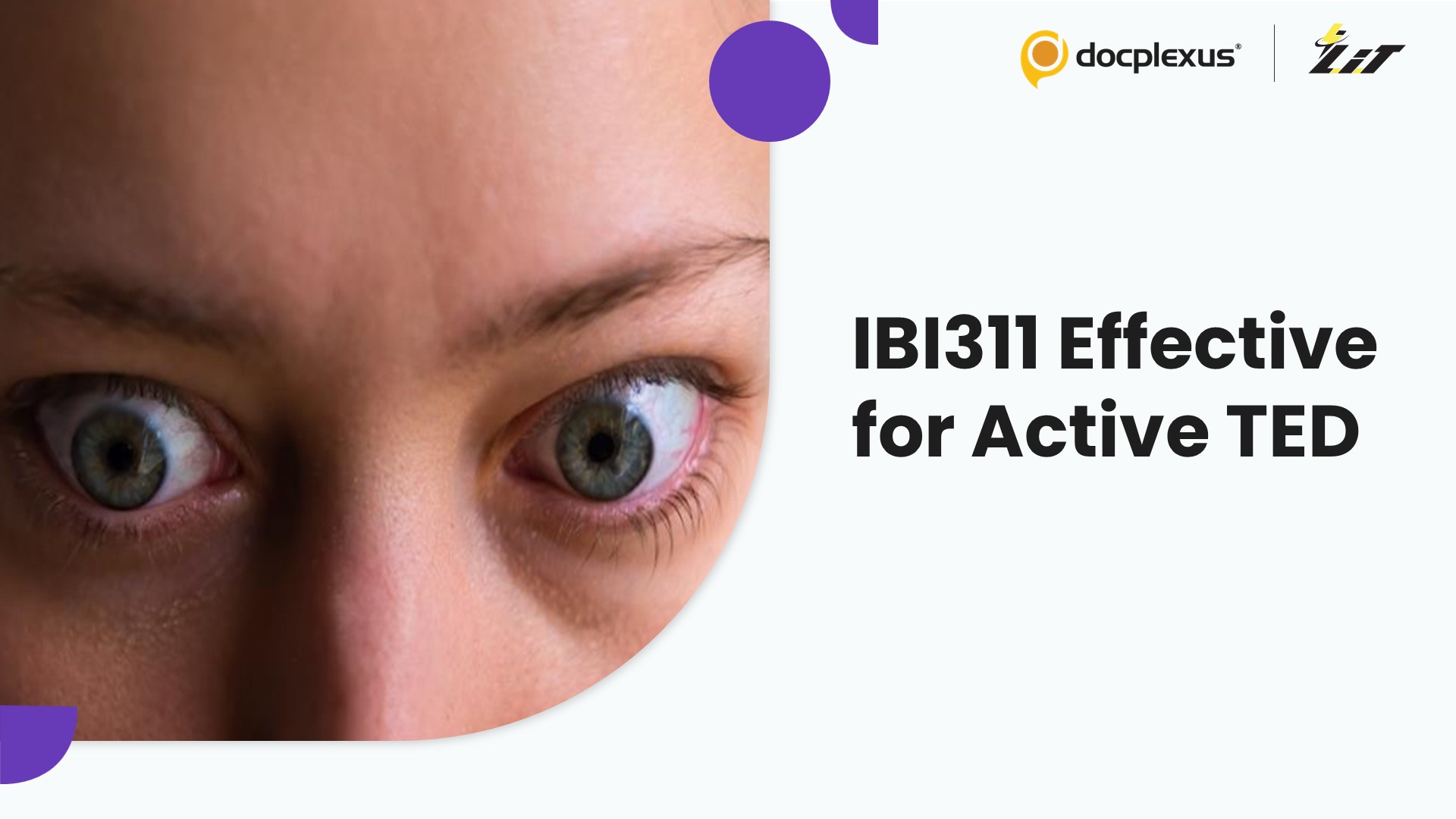 Promising Outcomes with IBI311 in the Treatment of Active Thyroid Eye Disease