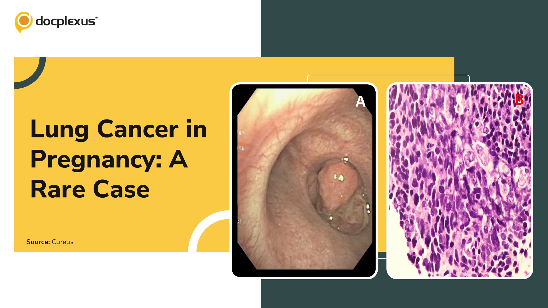 An Uncommon Gestational Presentation of Lung Cancer