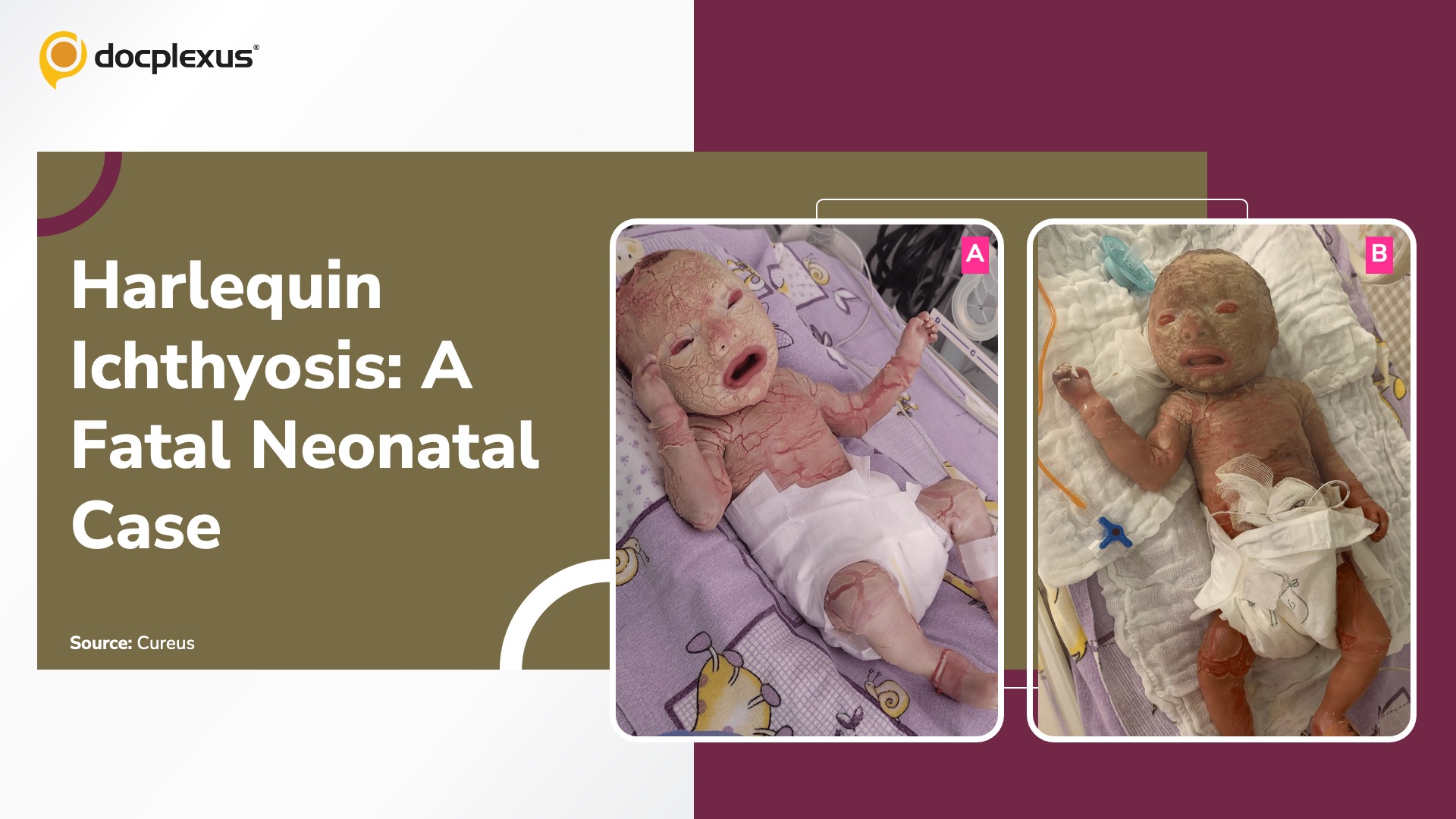 Harlequin Ichthyosis in a Neonate: A Severe Genetic Disorder