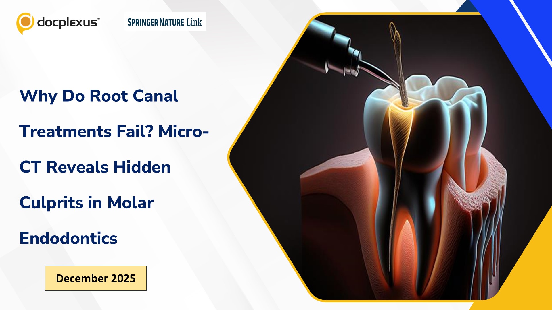 Why Do Root Canal Treatments Fail? Micro-CT Reveals Hidden Culprits in Molar Endodontics
