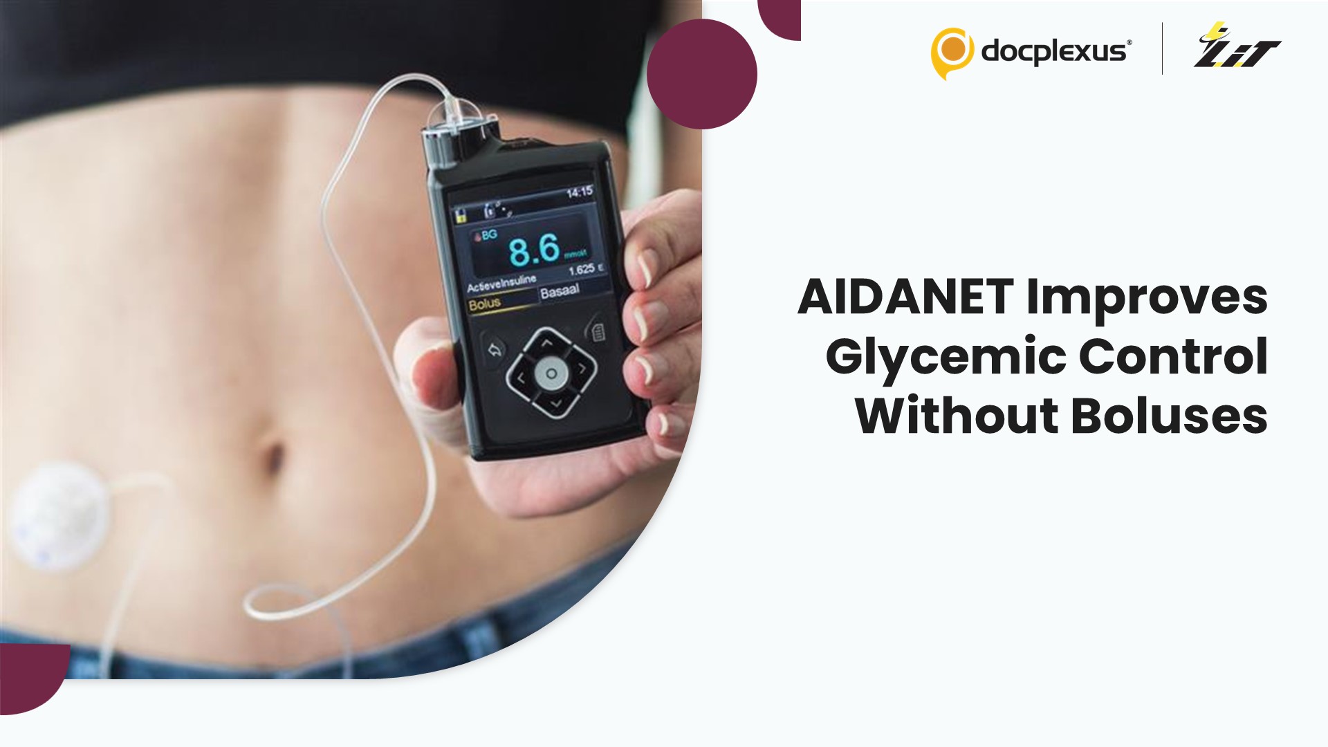 AIDANET Fully Closed-Loop System Improves Glycemic Control Without Mealtime Bolusing in T1D