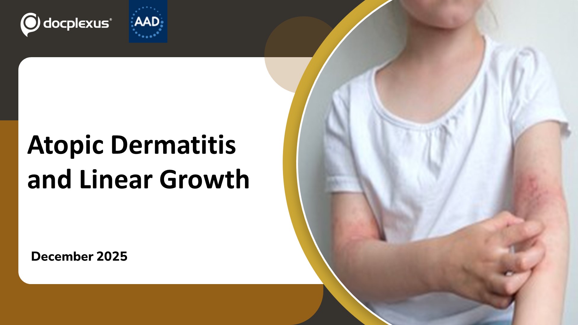 Do Kids With Eczema Really Grow Less? New Data Challenge Old Fears