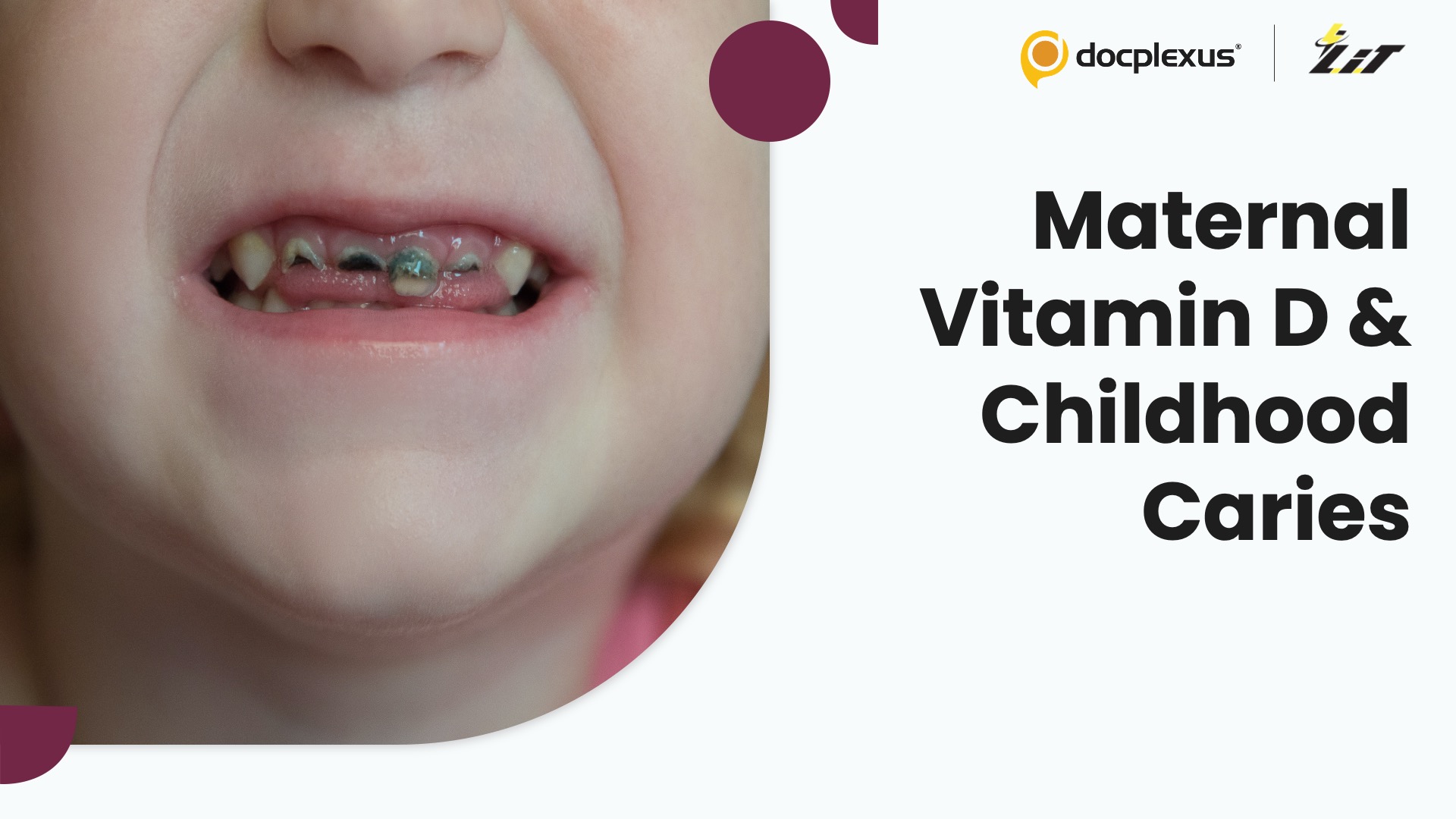 Higher Maternal Vitamin D Levels Linked to Lower Childhood Caries Risk