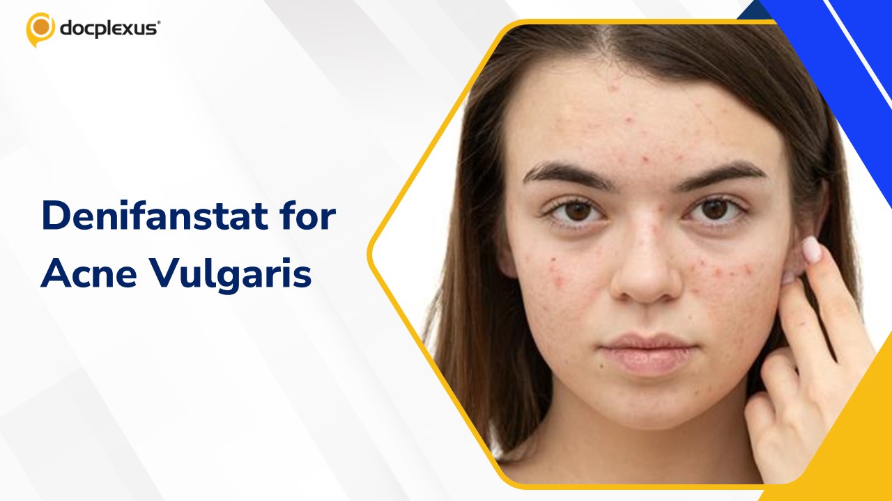 Denifanstat as a Potential Treatment for Moderate-to-Severe Acne Vulgaris