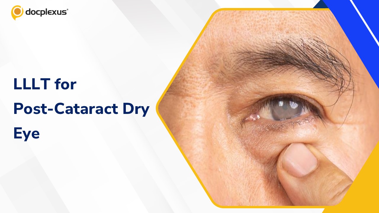 Perioperative LLLT for Preventing Dry Eye After Cataract Surgery
