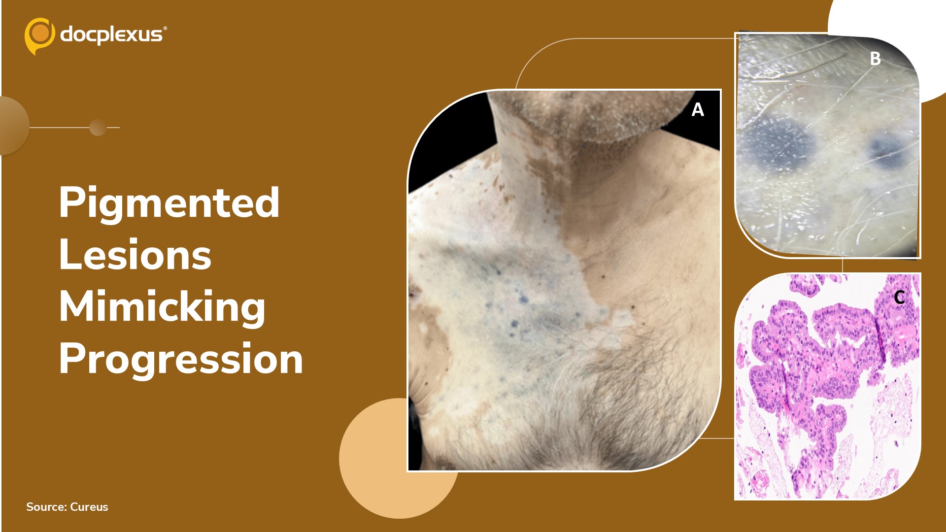 New Pigmented Lesions Mimicking Progression During Melanoma Immunotherapy