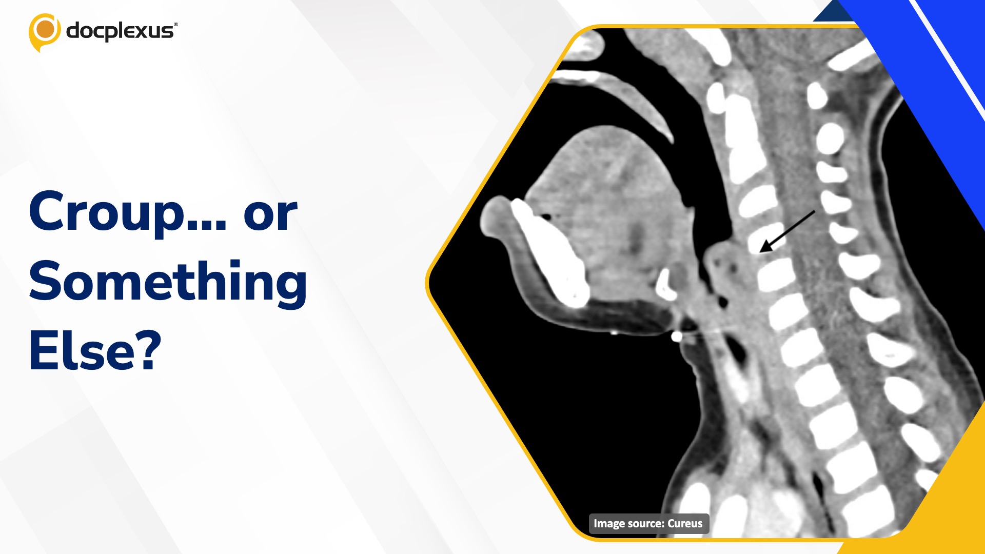 A Barking Cough That Wouldn’t Resolve: Can You Spot the Missed Diagnosis?