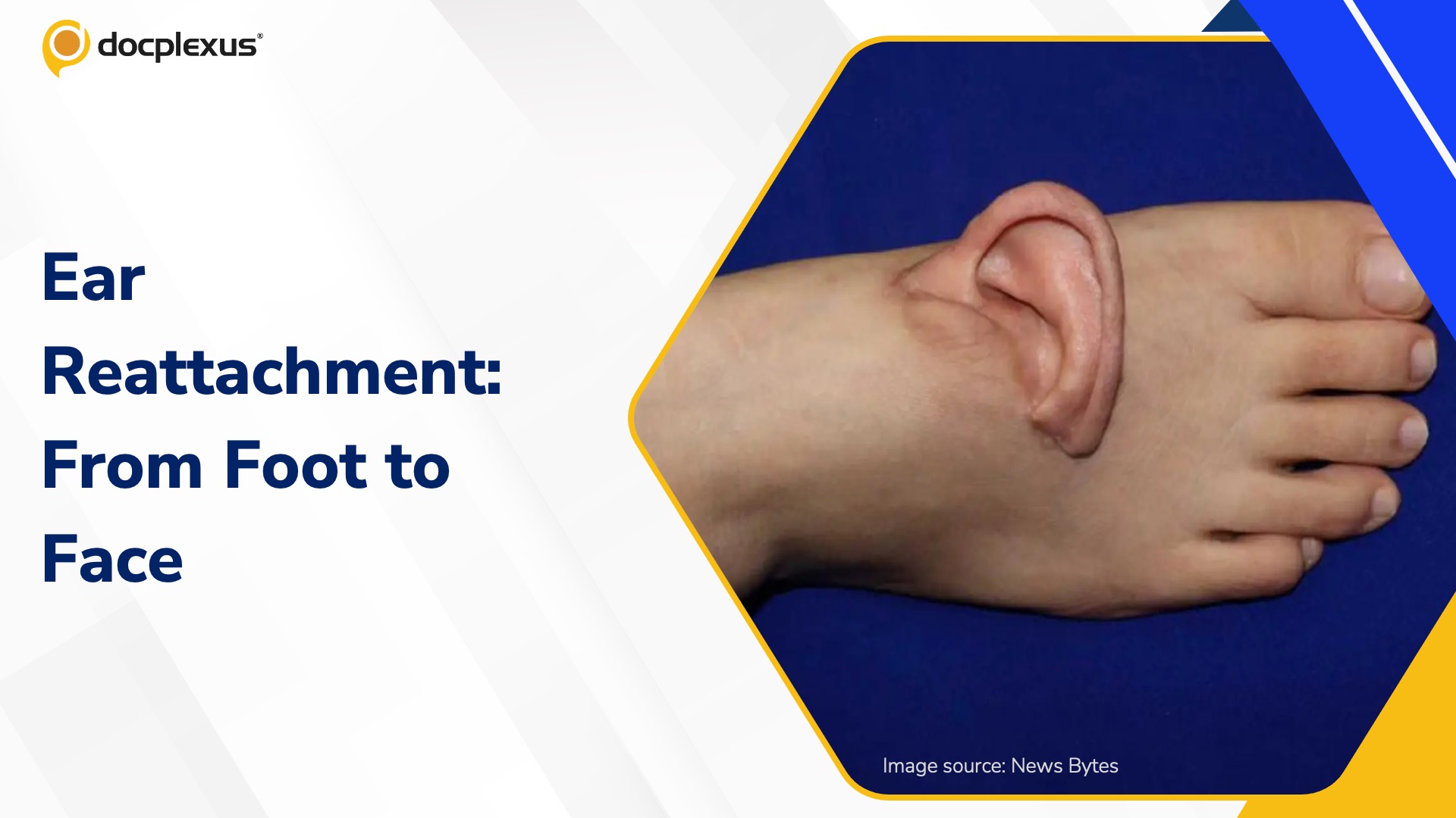 Chinese Surgeons Preserved a Severed Ear for Months Before Reattachment