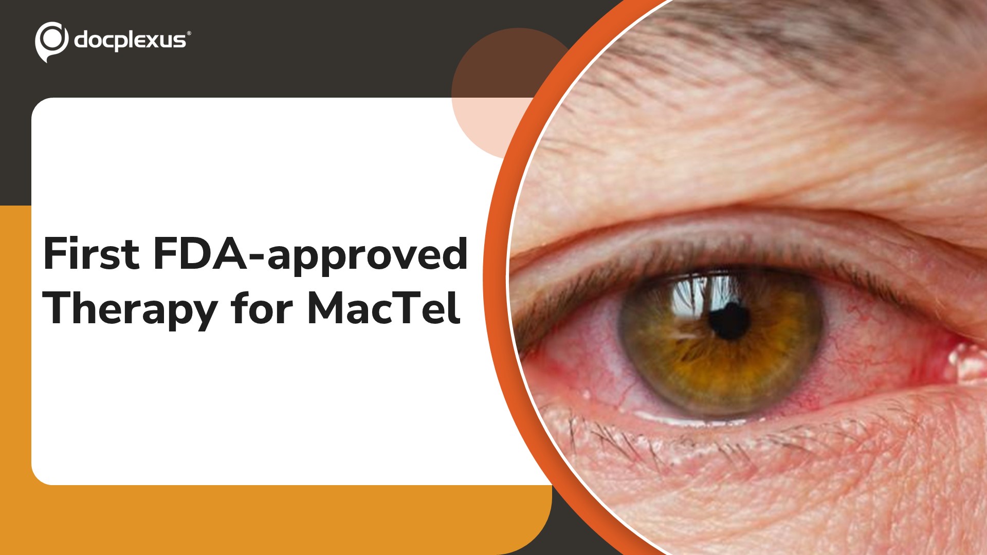USFDA Approves Revakinagene Taroretcel for Macular Telangiectasia Type 2