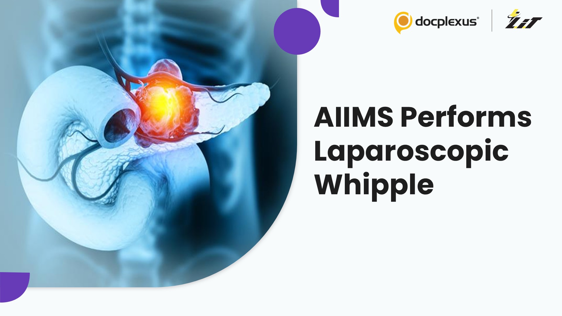 AIIMS Delhi Performs Historic Laparoscopic Whipple on Youngest Patient