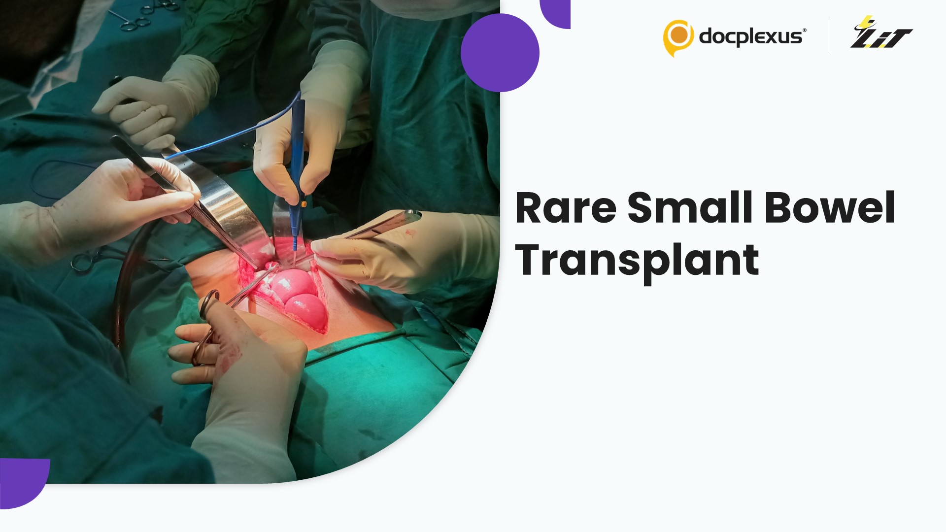 Mumbai Doctors Perform Small Bowel Transplant in a Rare Case