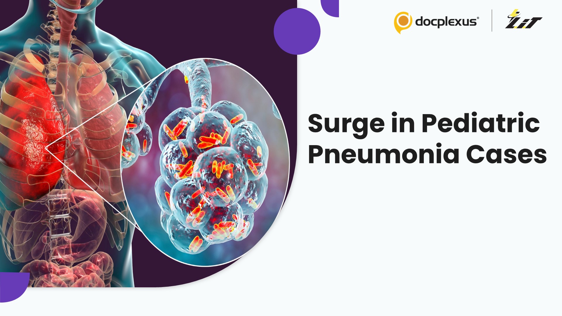 Bengaluru Doctors Report Rise in Pediatric Pneumonia